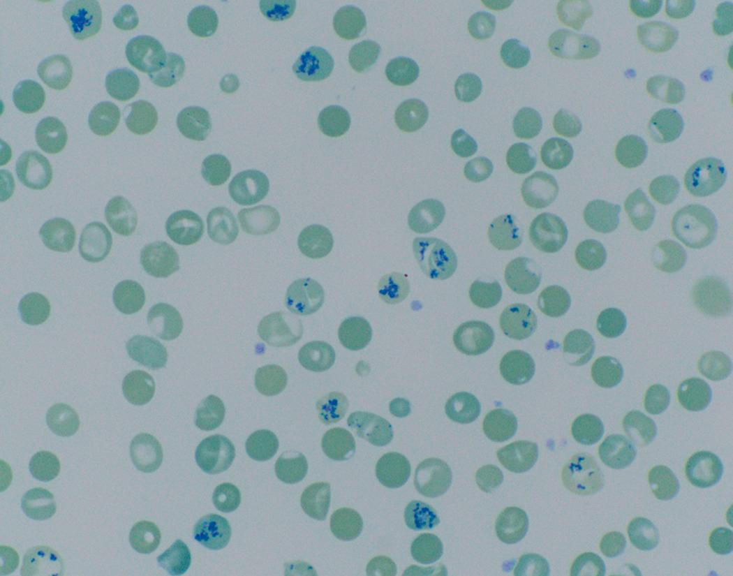Fig. 3.4, Anemia with striking reticulocytosis in hemoglobin H disease, seen when 3 of 4 α-globin genes become inactive and there is an excess of β-globin chains forming tetramers also known as hemoglobin H supravital stain (100× objective). In some cases, a characteristic golf-ball appearance may be seen from denatured hemoglobin H associated with the membrane; however, that was not present in this case. The staining here is due to the pattern of ribosomes in the immature red blood cells.