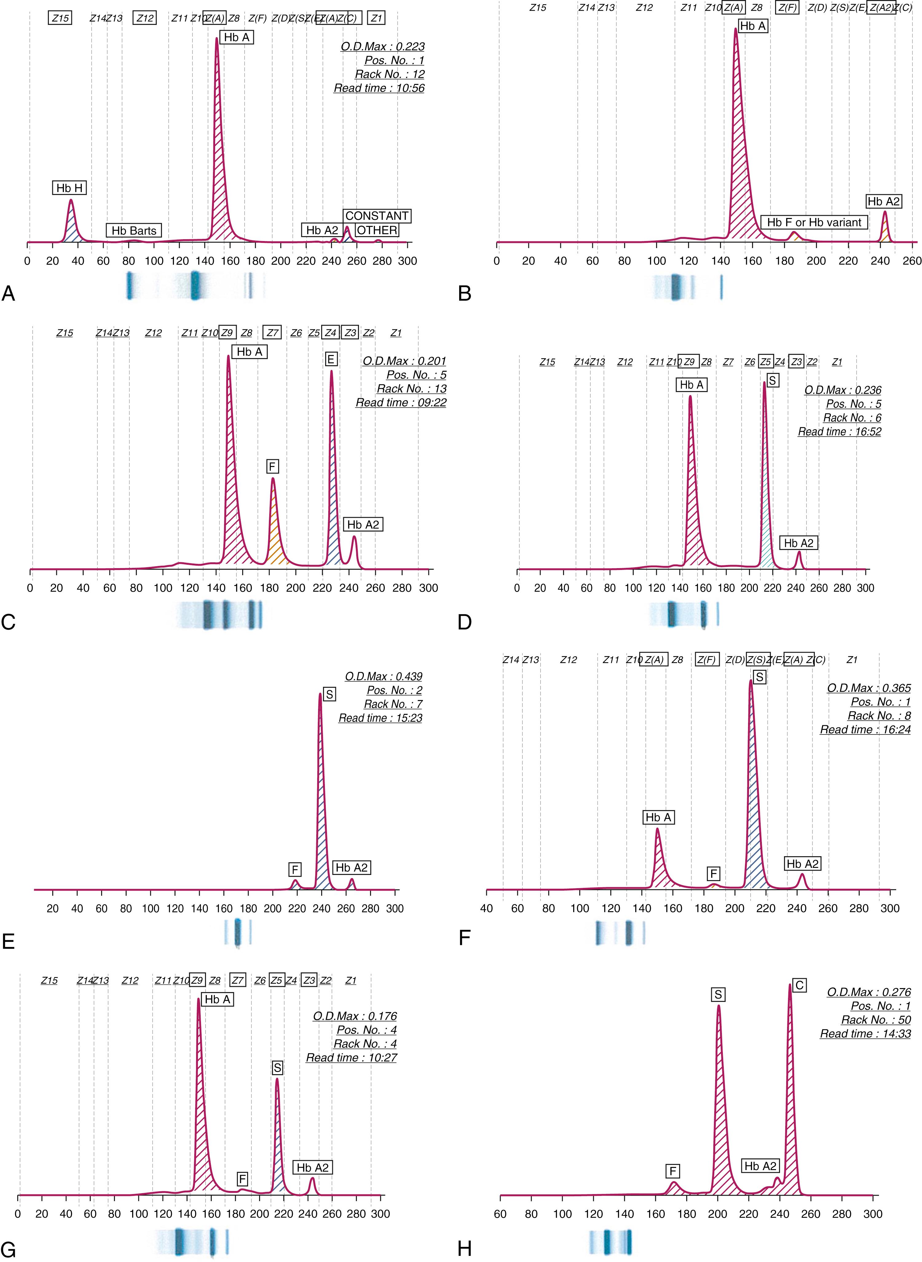 Fig. 3.5, Ion exchange high-performance liquid chromatography (HPLC) used to separate hemoglobins with corresponding alkaline electrophoresis gels.