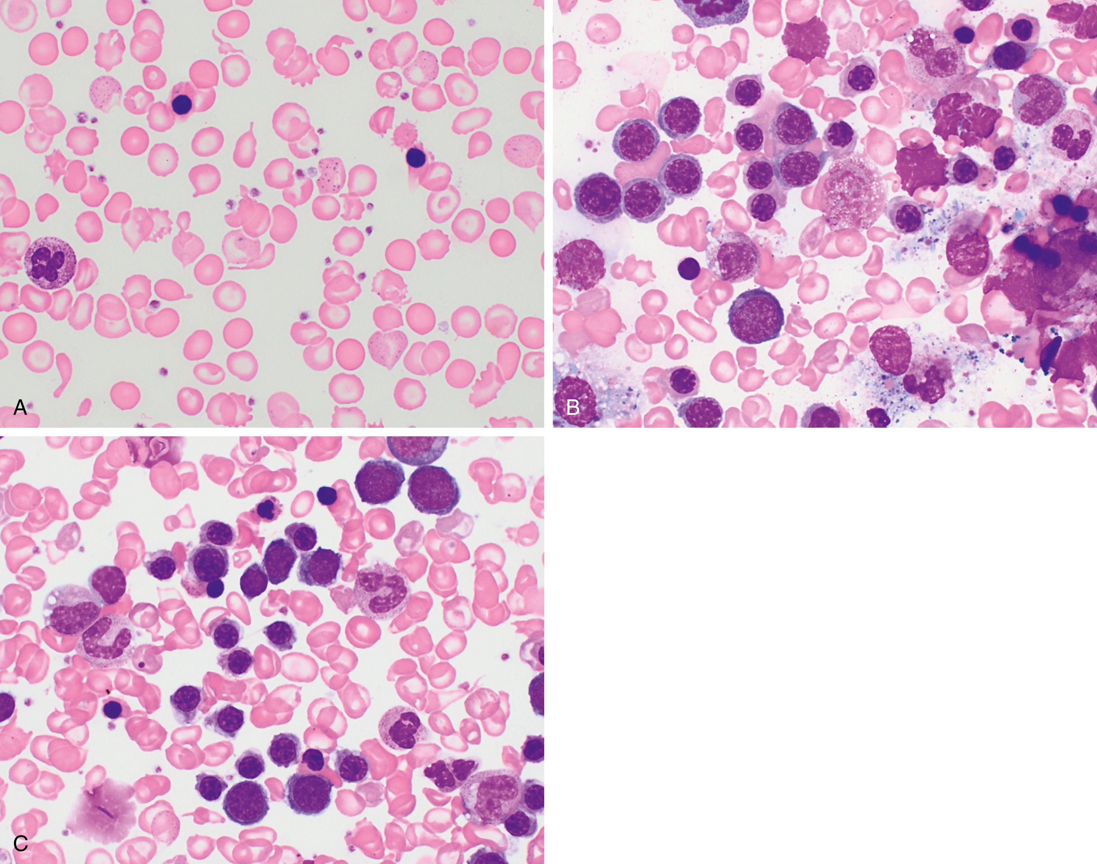 Fig. 3.6, β-Thalassemia major.