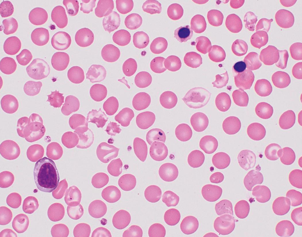 Fig. 3.7, β-Thalassemia minor.