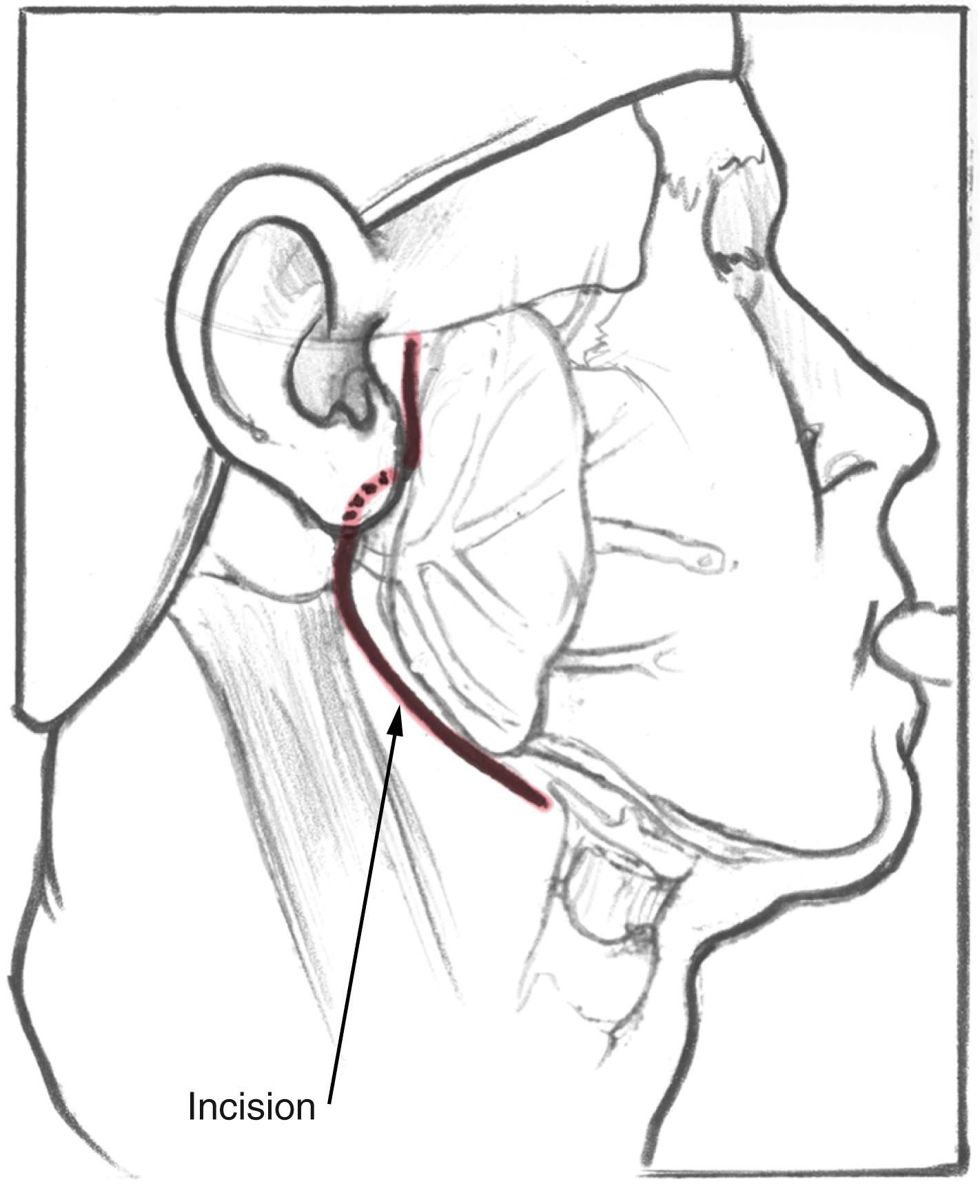 Fig. 57.1, A lazy S standard parotidectomy incision is used in this procedure. The scar is well hidden in the preauricular crease and in the natural skin crease in the submandibular area.
