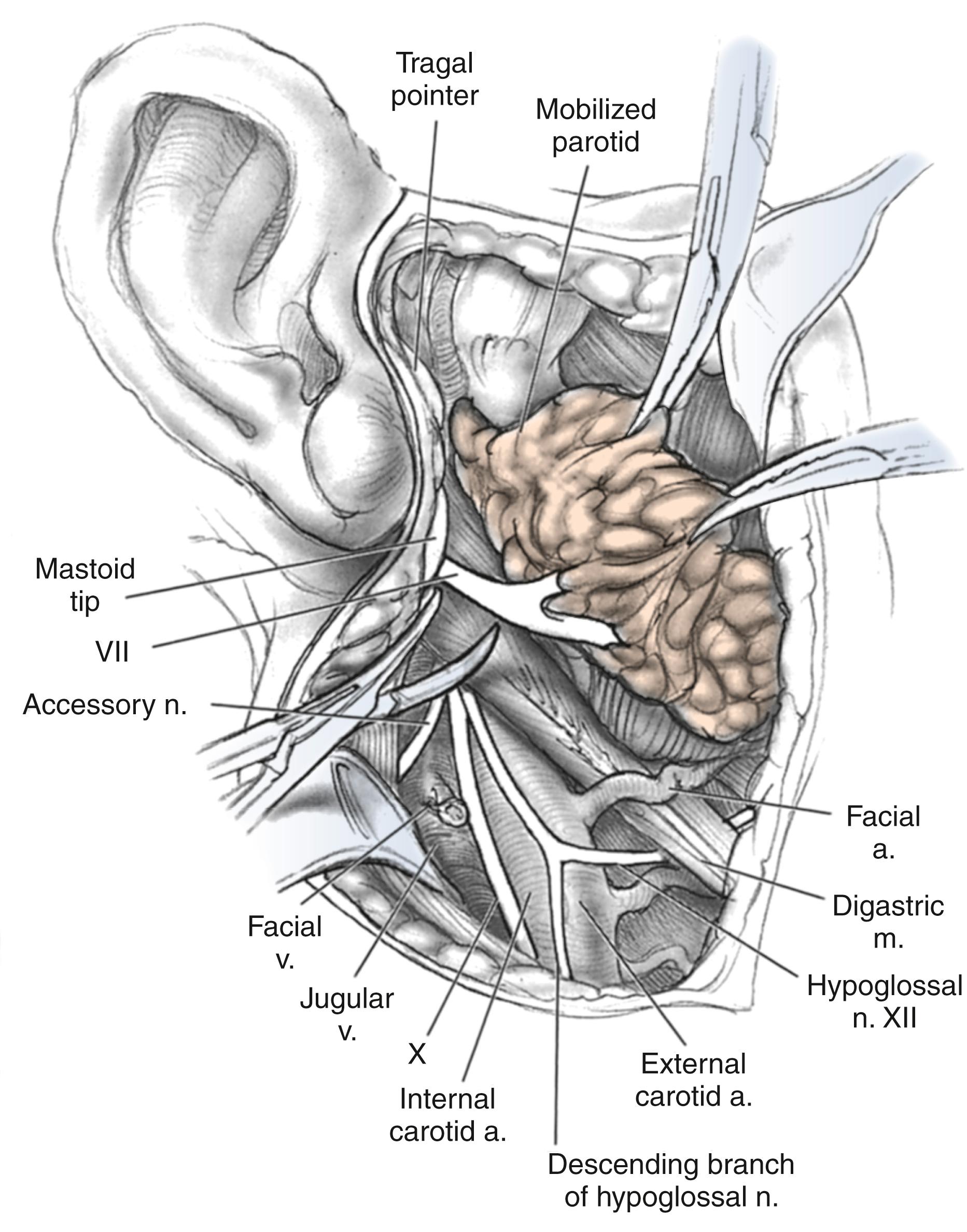 Fig. 57.2, The parotid gland is mobilized anteriorly and superiorly as the sternocleidomastoid muscle is retracted posteriorly, exposing the facial and hypoglossal nerves.