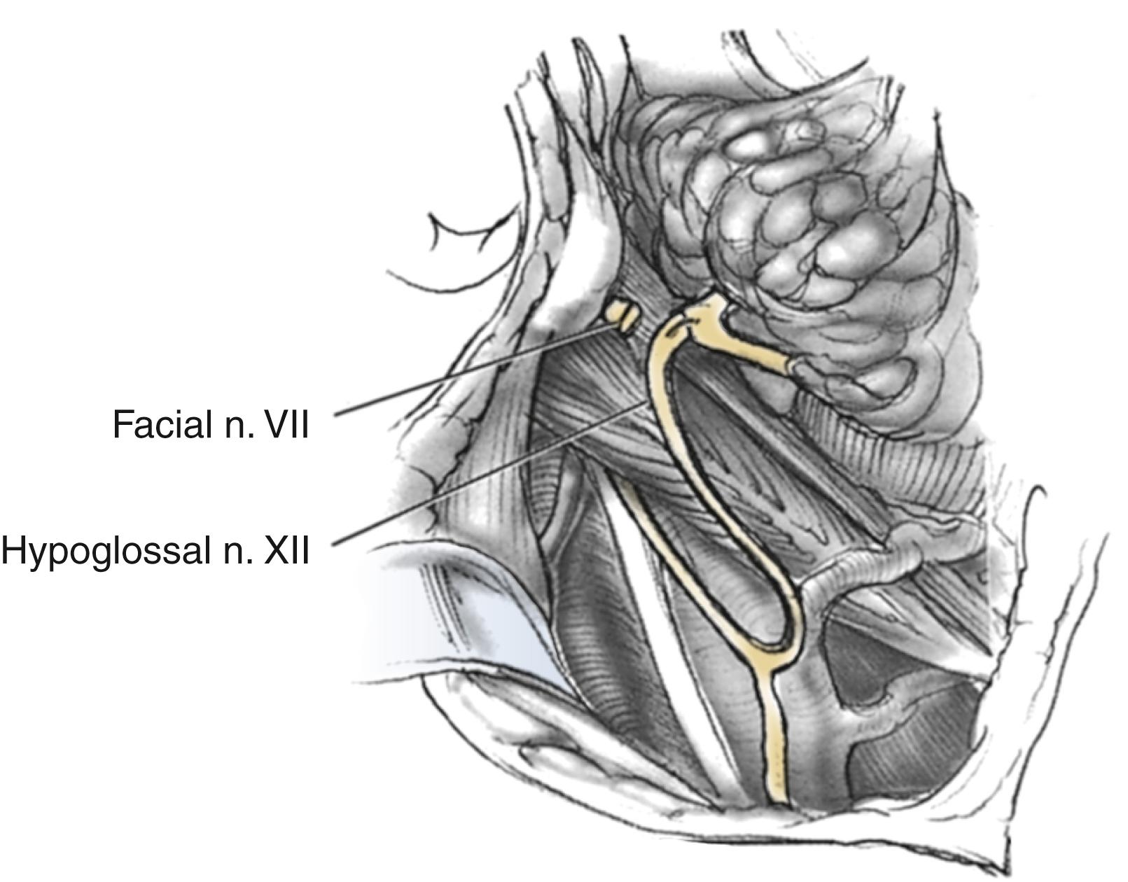 Fig. 57.3, The proximal end of hypoglossal nerve is anastomosed to the distal end of facial nerve. Care is taken to use the maximal length of each nerve to achieve tension-free anastomosis.