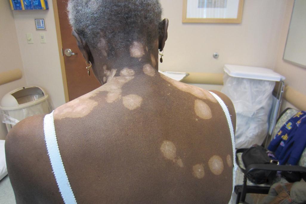 Fig. 8.1, Trichrome Vitiligo.