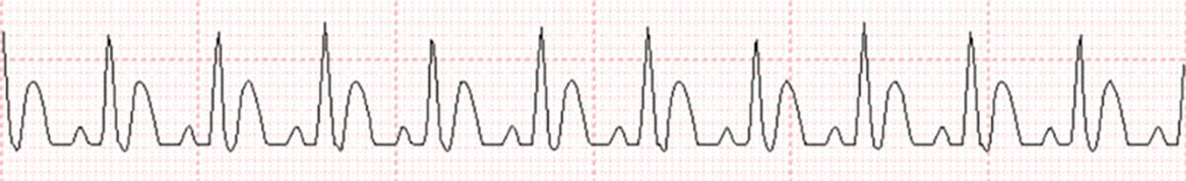 Fig. 56.1, Telemetry strip showing sinus tachycardia at 110 bpm with peaked T waves