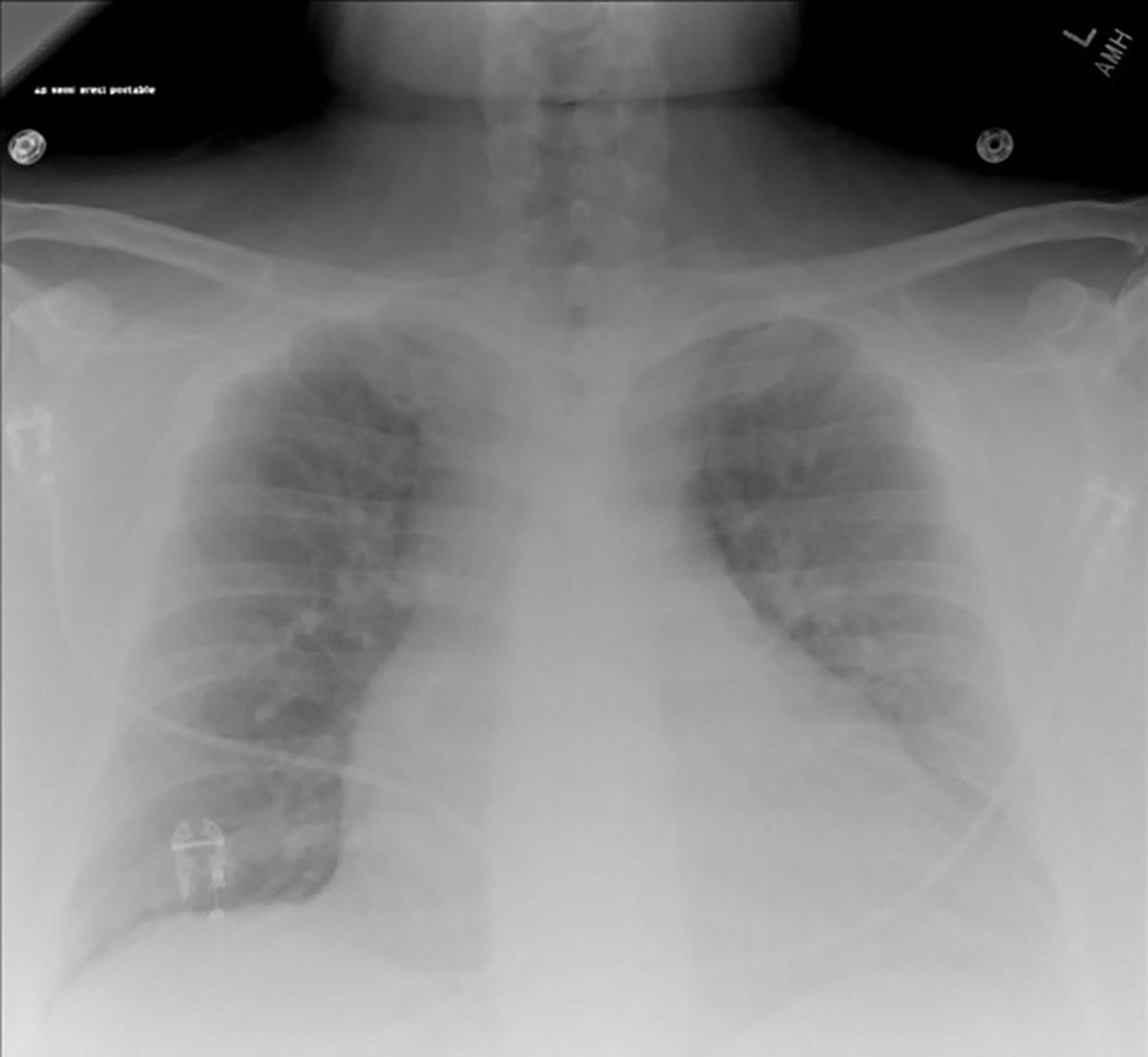 Fig. 12.1, Chest X-ray in an anteroposterior view showing pulmonary vascular congestion and globular heart.