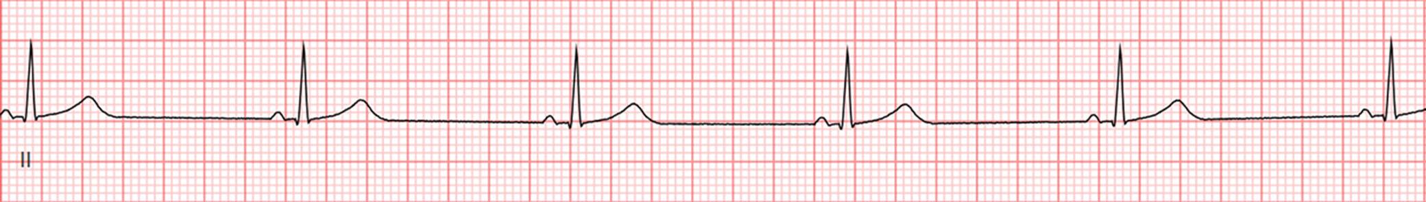 Fig. 58.1, Telemetry strip showing sinus bradycardia with a heart rate of 48 bpm.