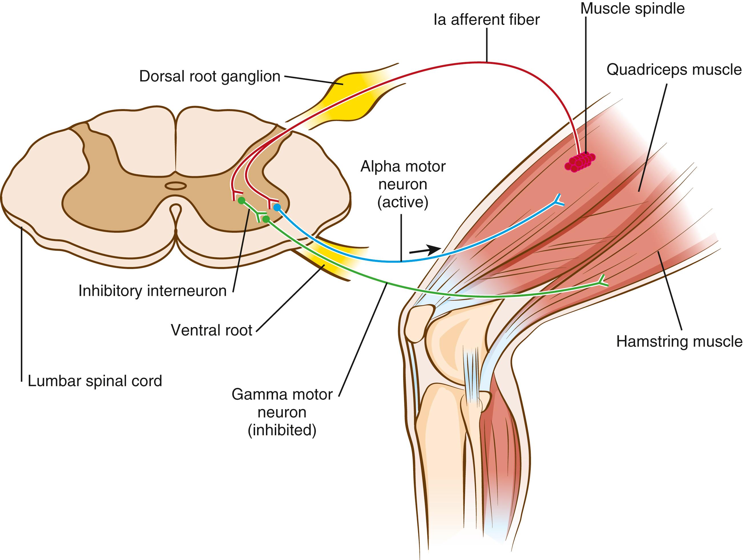 Fig. 35.2, Lower motor neuron pathway influencing resting muscle tone. Stretching of the quadriceps muscle (agonist) will result in relaxation or inhibition of the hamstring muscle (antagonist).