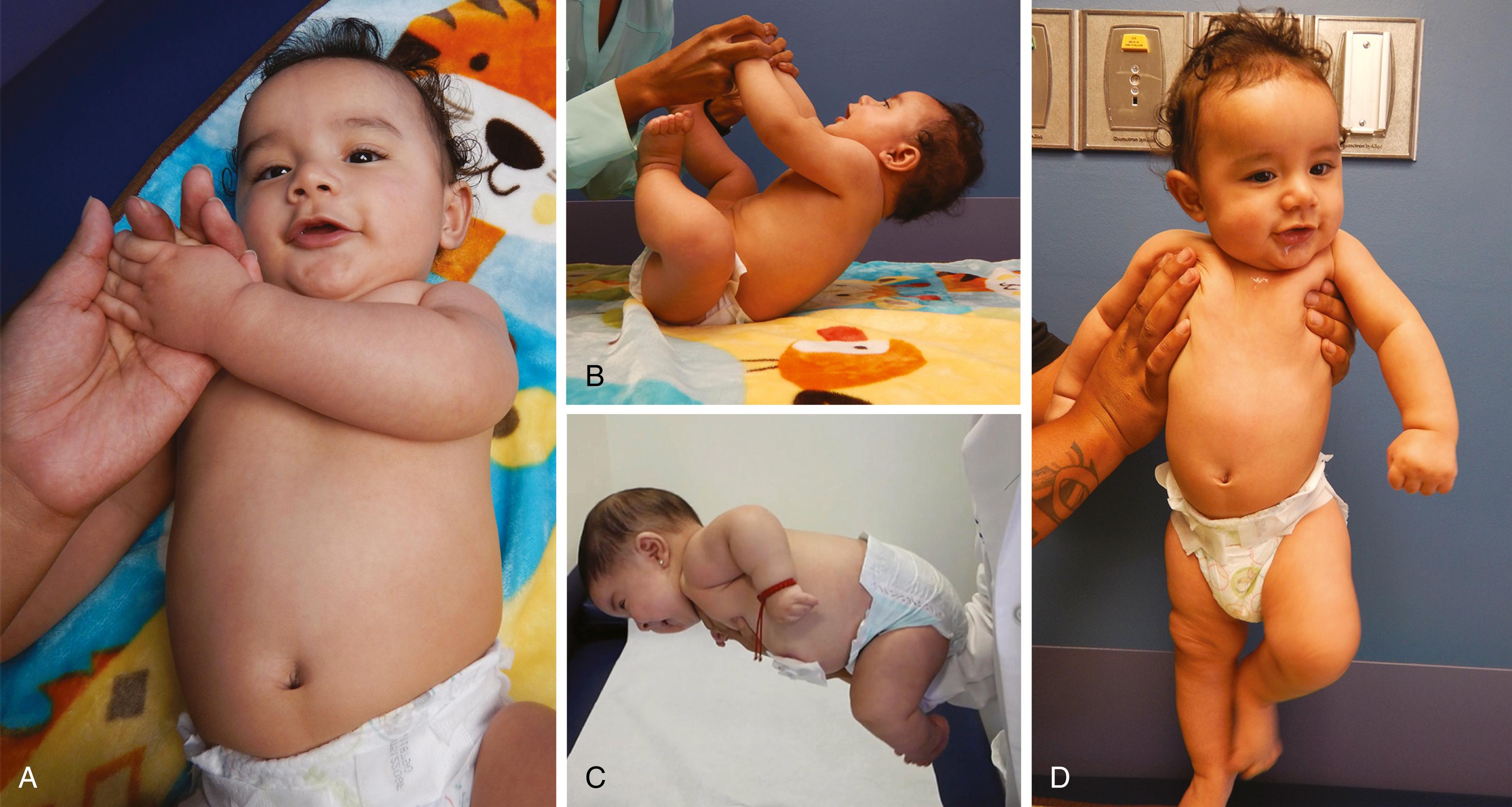 Fig. 35.3, Normal postural responses in a 5-month-old infant showing that the elbow does not extend beyond the midline on joint extensibility testing (A), the head and body in the same plane (no head lag) on pull-to-sit with resistance resulting in flexed elbows and knees (B), and lack of a slip-through with resistance against the examiner’s hands, good maintenance of head control, and extension of the head and legs with the steppage reflex (D). An infant with hypoxic-ischemic encephalopathy who was initially hypotonic at the time of delivery was noted to be hypertonic at 8 months with a normal ventral suspension response as evidenced by the ability to keep the head above horizontal (C).