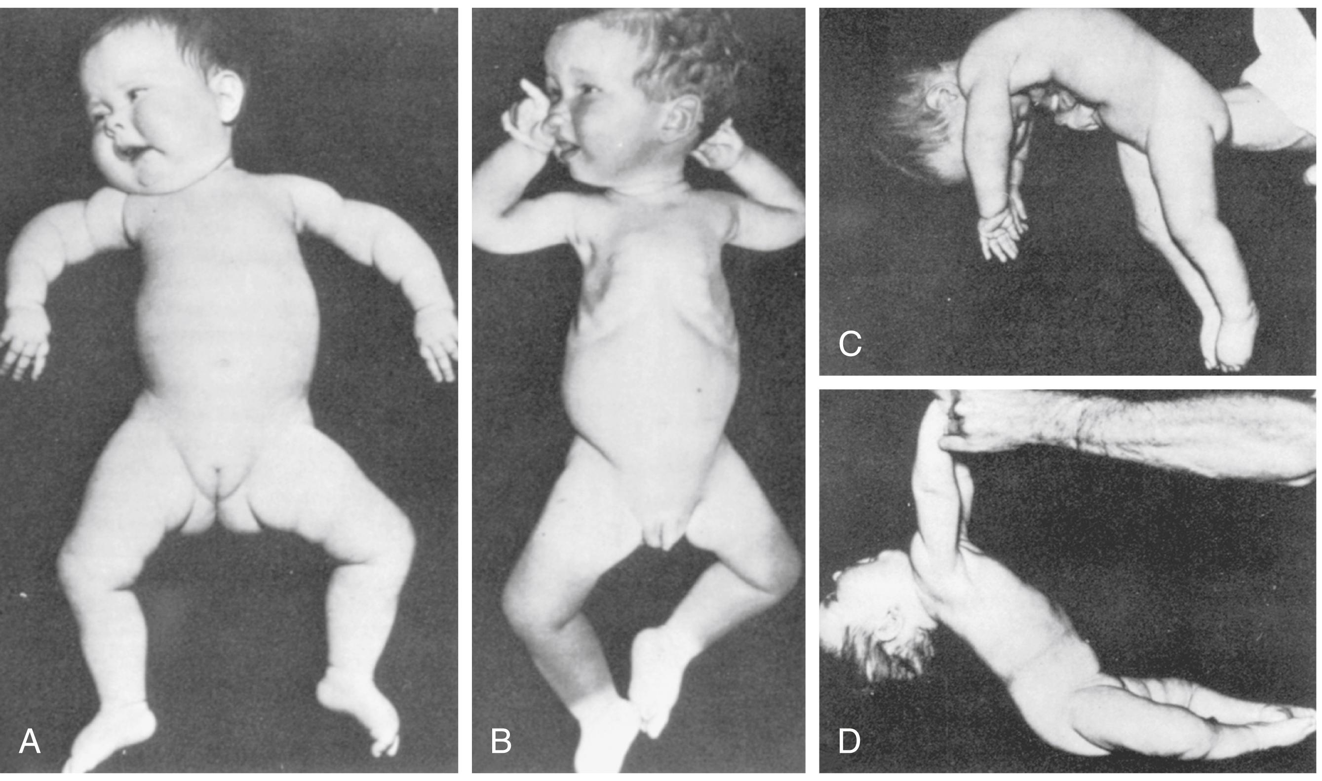 Fig. 35.4, Spinal muscular atrophy I: characteristic postures. A, A 6-week-old infant with severe weakness and hypotonia from birth. Note the frog-leg posture of the lower limbs and internal rotation (“jug-handle”) at the shoulders. B, A 1-year-old infant with frog-leg posture, external rotation at shoulders, intercostal recession, and normal facial expressions. A 6-week-old infant with marked weakness of the limbs and trunk giving the characteristic inverted “U” appearance on ventral suspension (C) and pull-to-sit (D).