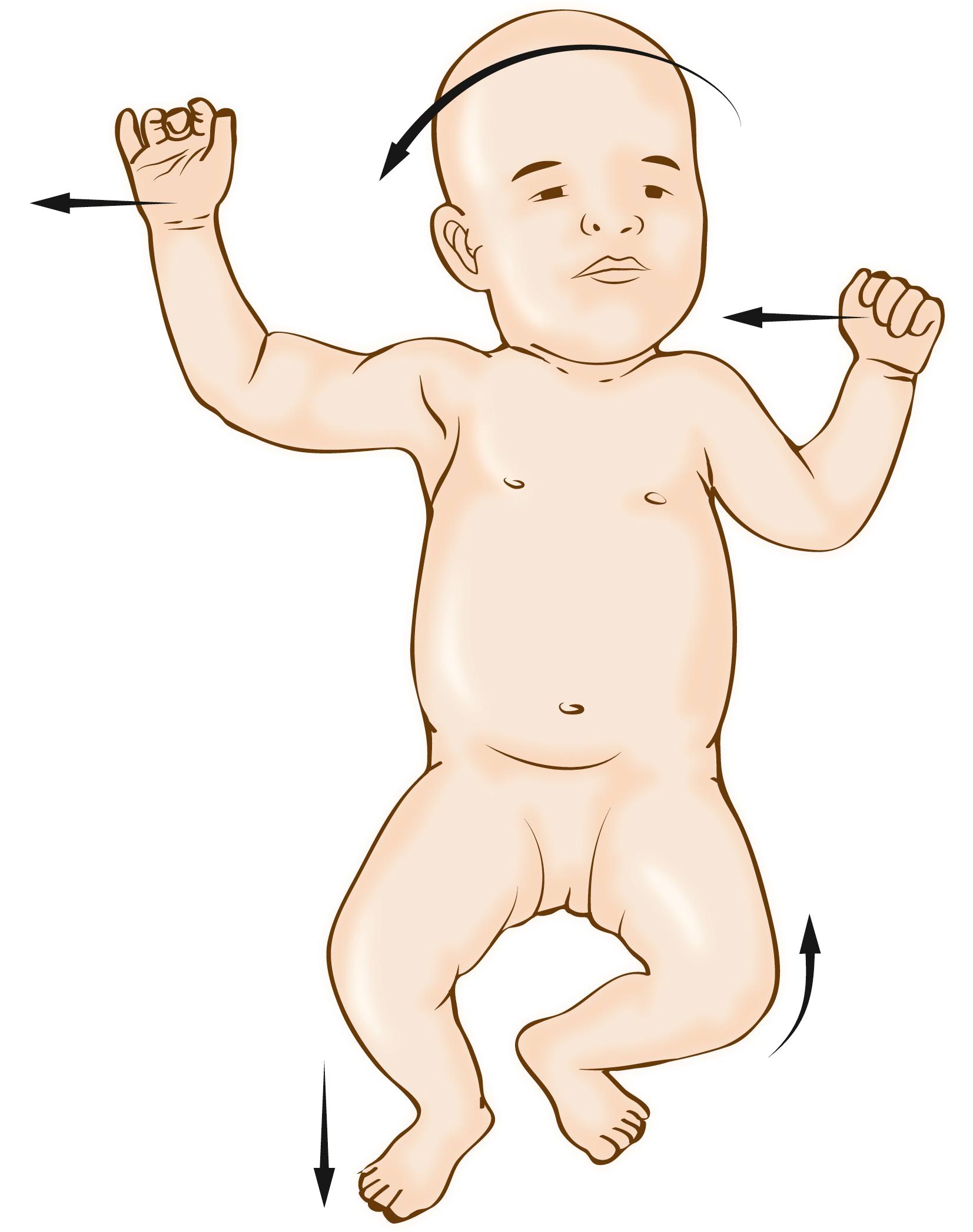 Fig. 35.6, Asymmetric tonic neck reflex. Normally present from birth to 2 months. Turning head to one side when supine elicits extension of arm and leg ipsilateral to side that head is turned and flexion of opposite arm and leg. Persistence beyond 2 months might suggest abnormal development of contralateral motor cortex.