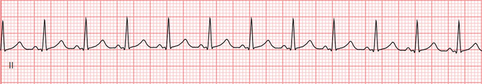 Fig. 20.1, Telemetry strip showing sinus tachycardia at almost 122 beats per min.