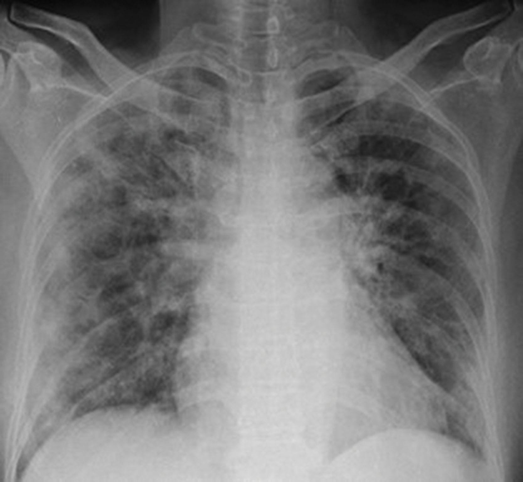 Fig. 20.2, Chest X-ray showing diffuse bilateral opacities.