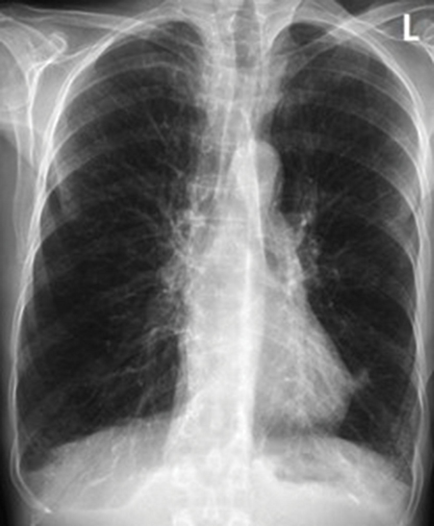 Fig. 23.1, Chest X-Ray in the anteroposterior view showing hyperinflated lungs.