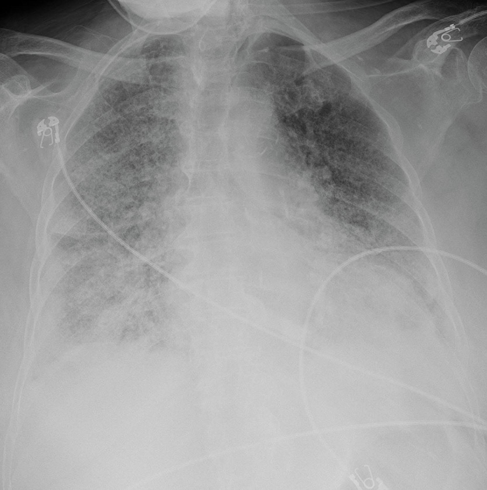 Fig. 25.1, Chest X-ray showing bilateral pulmonary vascular congestion.