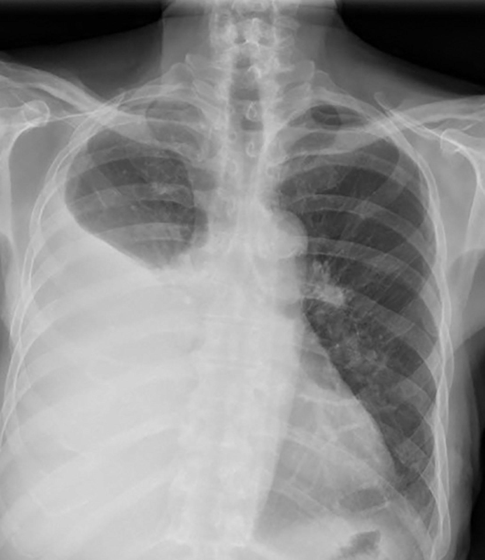 Fig. 29.1, Right-sided pleural effusion.