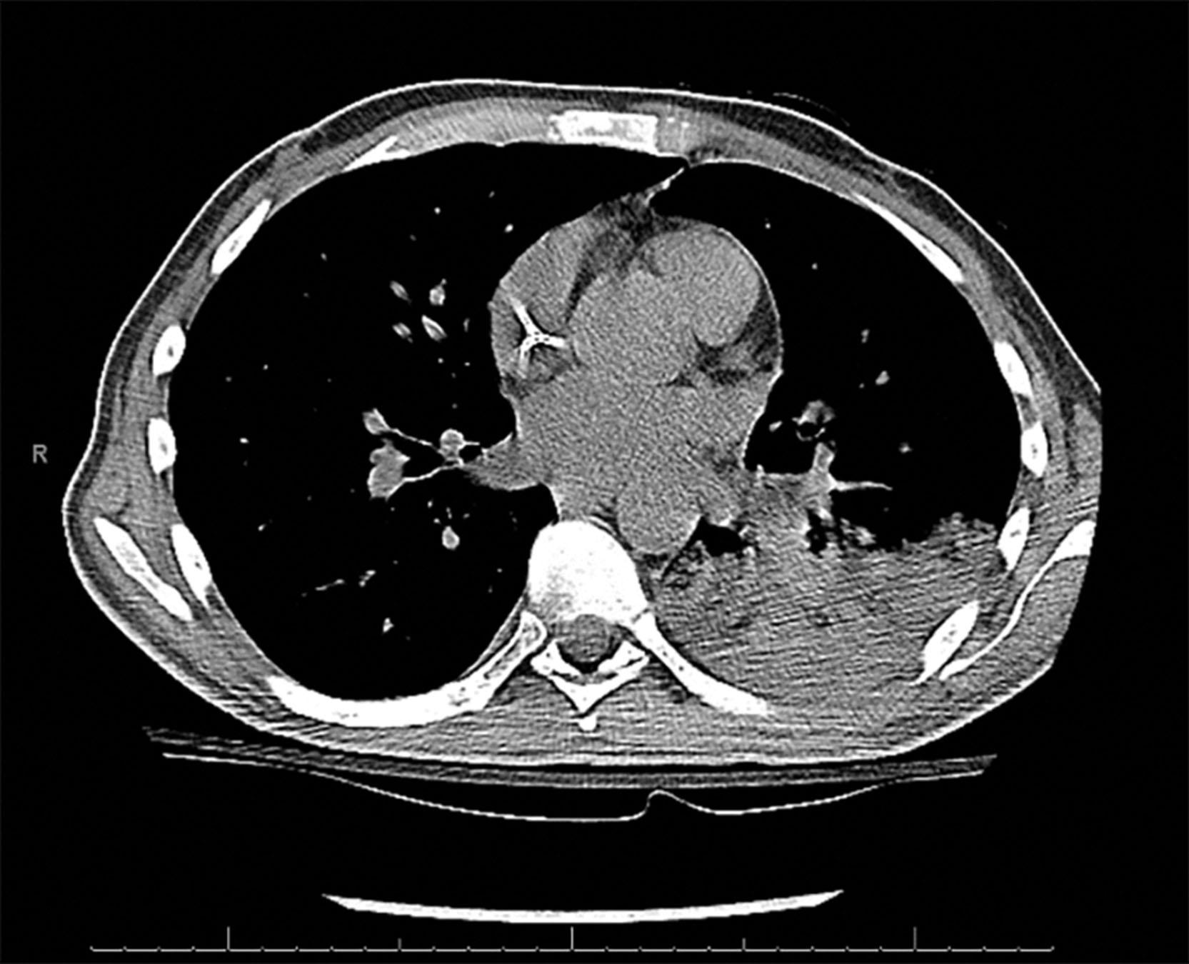 Fig. 27.1, Computed tomography scan showing the collapse of left lower lobe and questionable infiltrate because of suspected mucous plugging of left lower lobe bronchus.