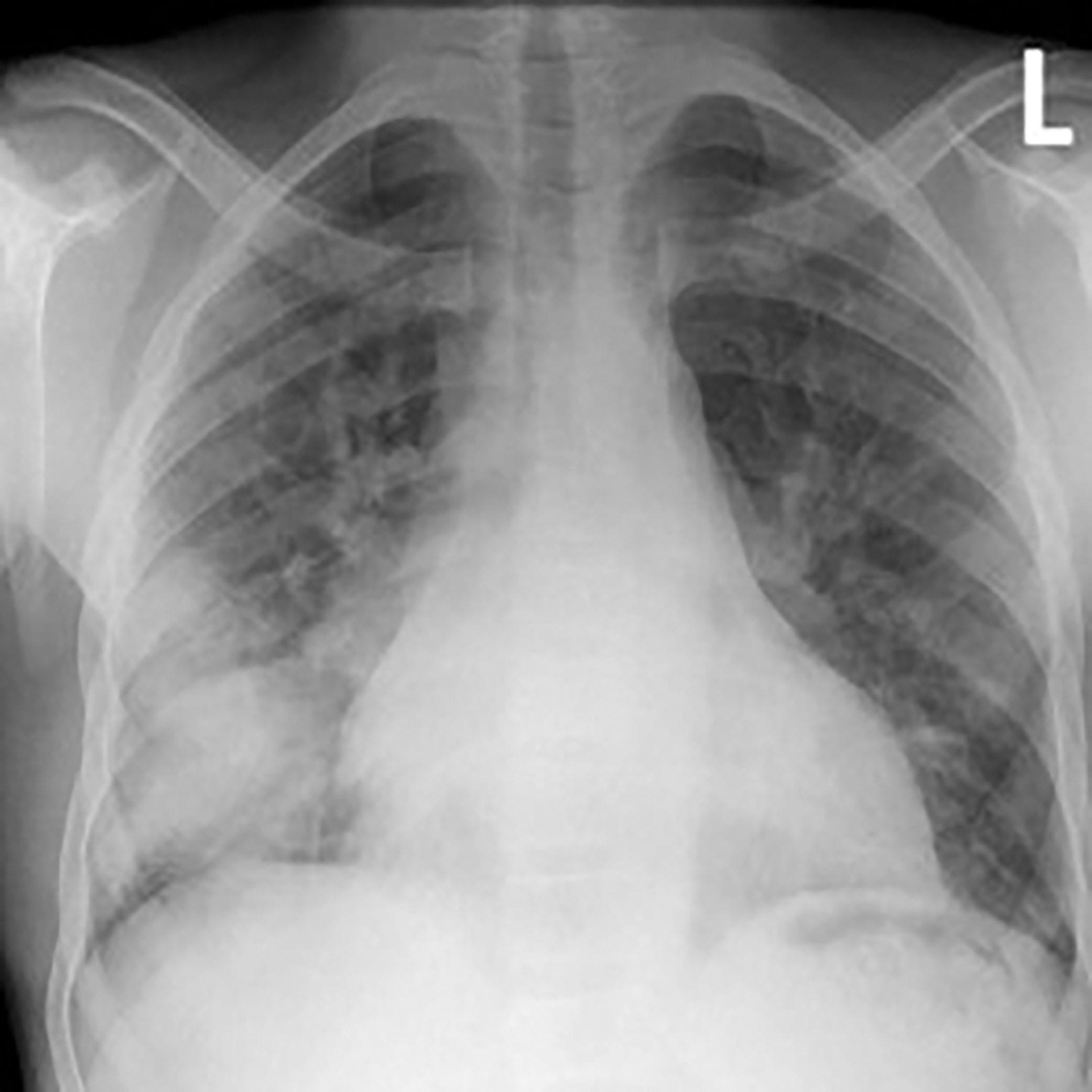 Fig. 28.1, Chest X-Ray anteroposterior view in a patient with acute chest syndrome showing new infiltrate.