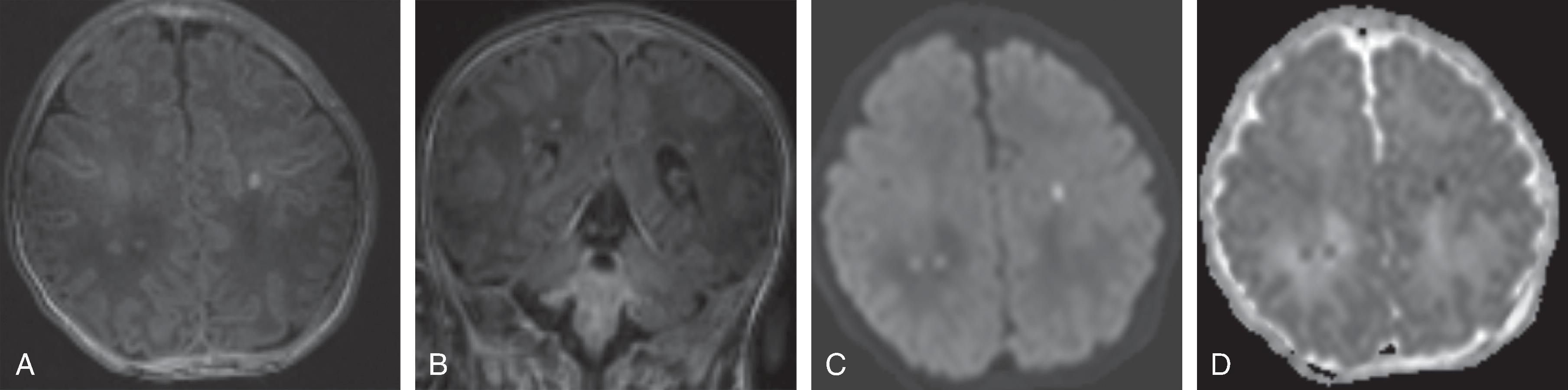 Fig. 3.1, Hypoxic Ischemic Injury .