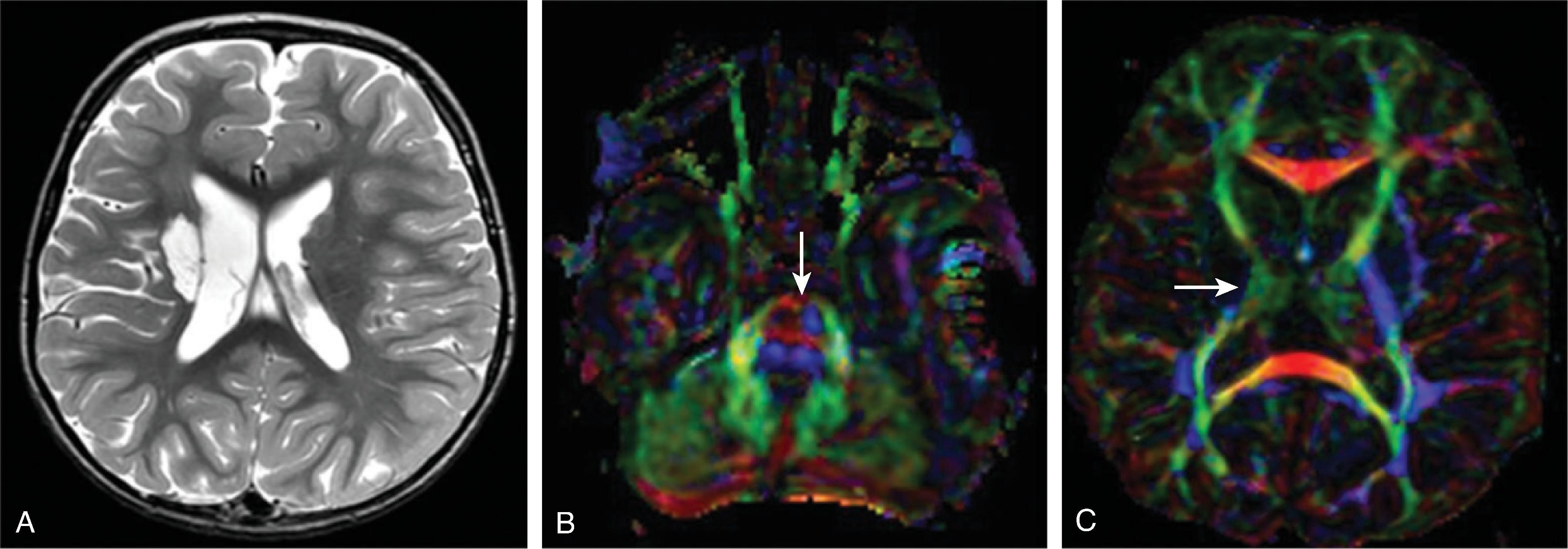 Fig. 3.13, Chronic Stroke .