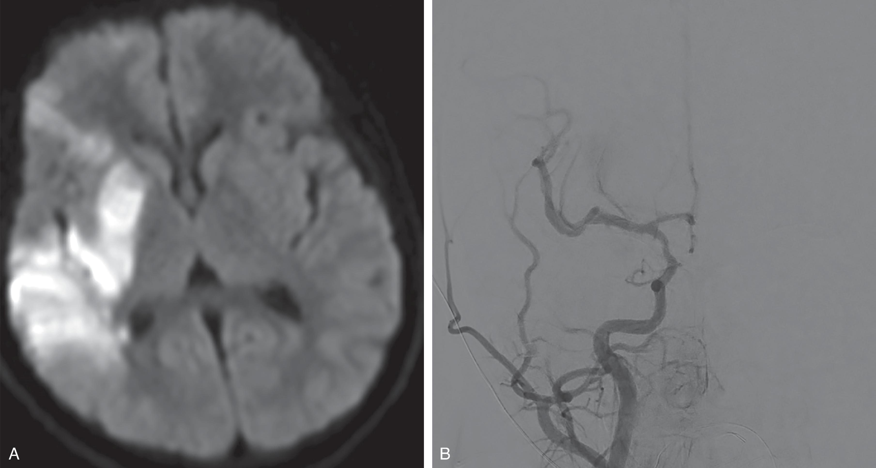 Fig. 3.14, Focal Cerebral Arteriopathy .