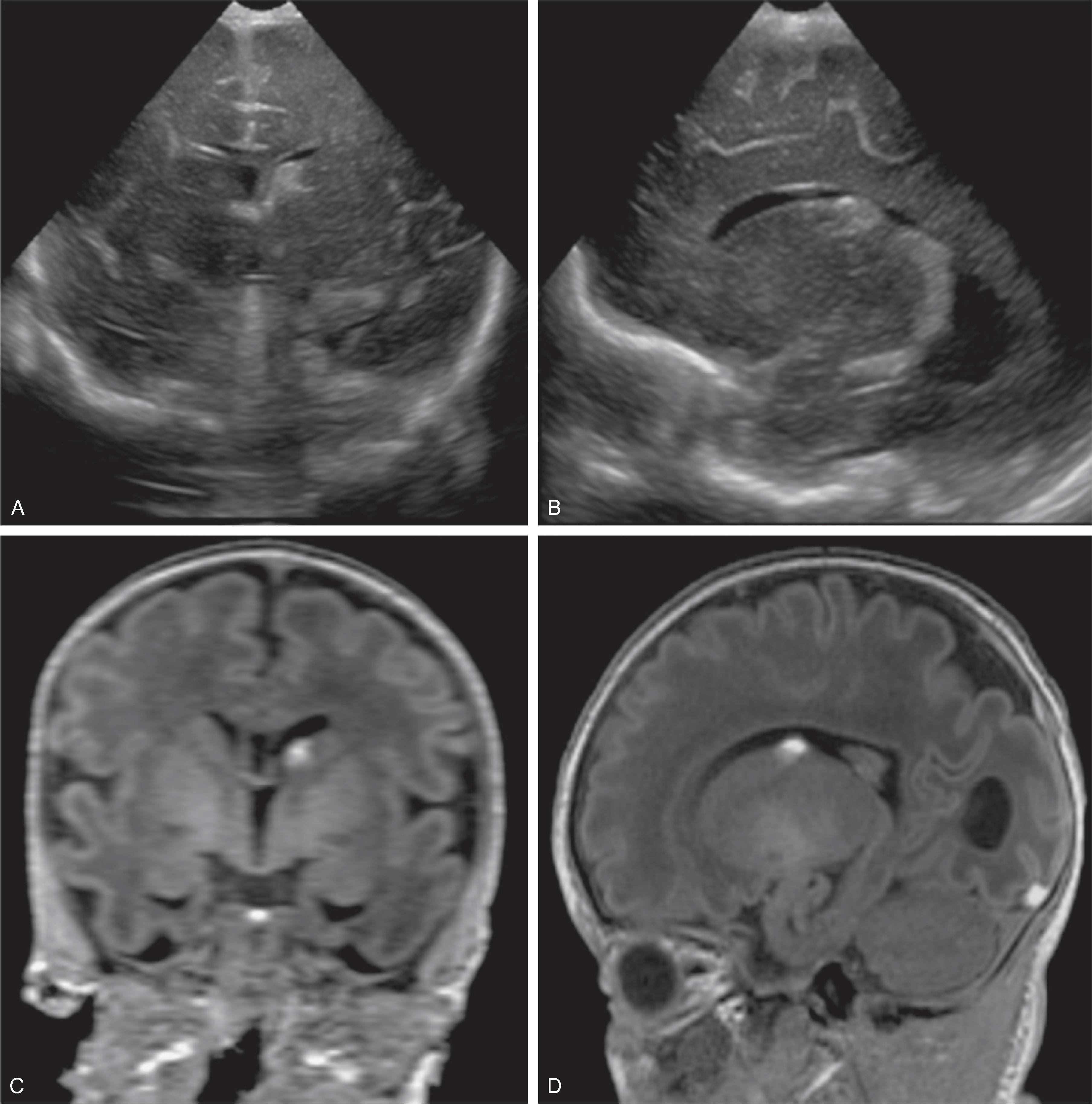 Fig. 3.18, Germinal Matrix Hemorrhage - Grade 1 .