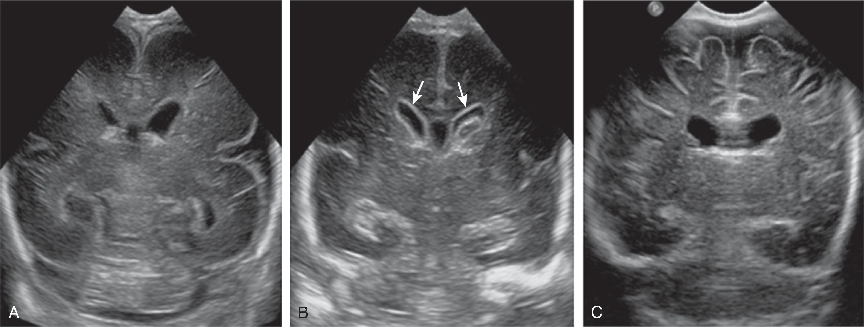 Fig. 3.19, Germinal Matrix Hemorrhage - Grade 2 .