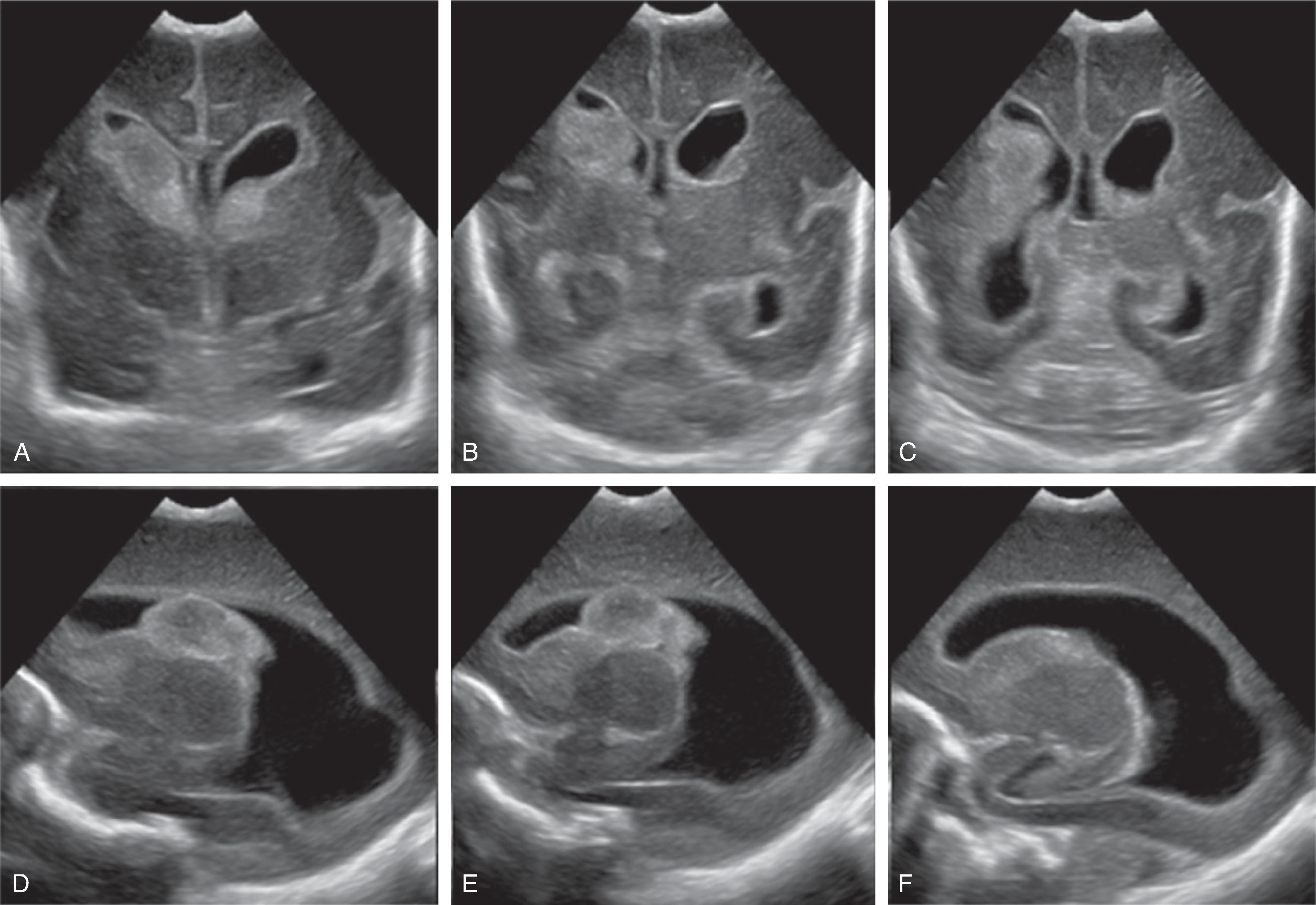 Fig. 3.20, Germinal Matrix Hemorrhage - Grade 3 .