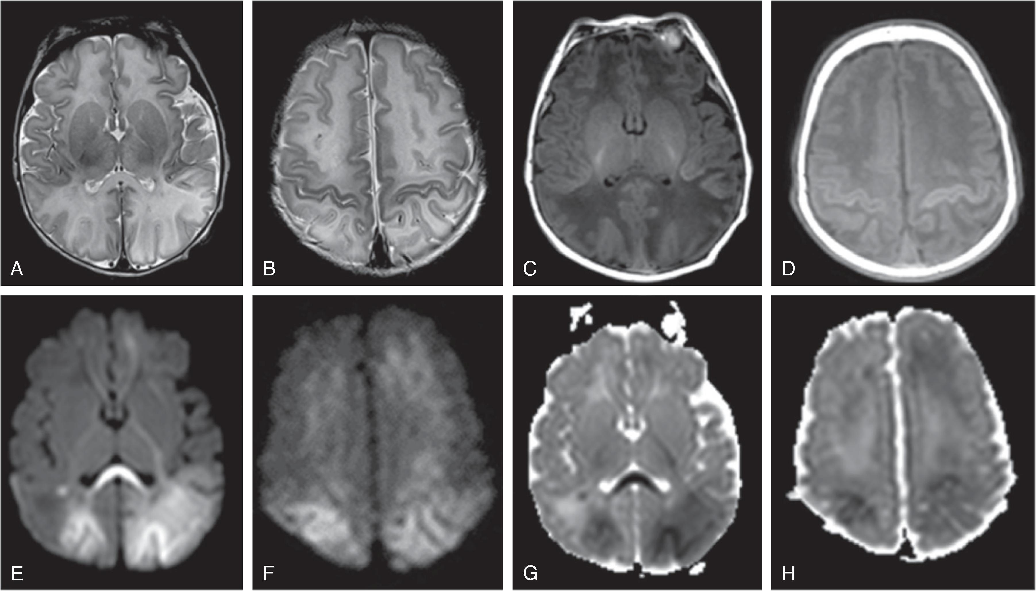 Hypoxic Ischemic Injury and Cerebrovascular Disorders - Clinical Tree