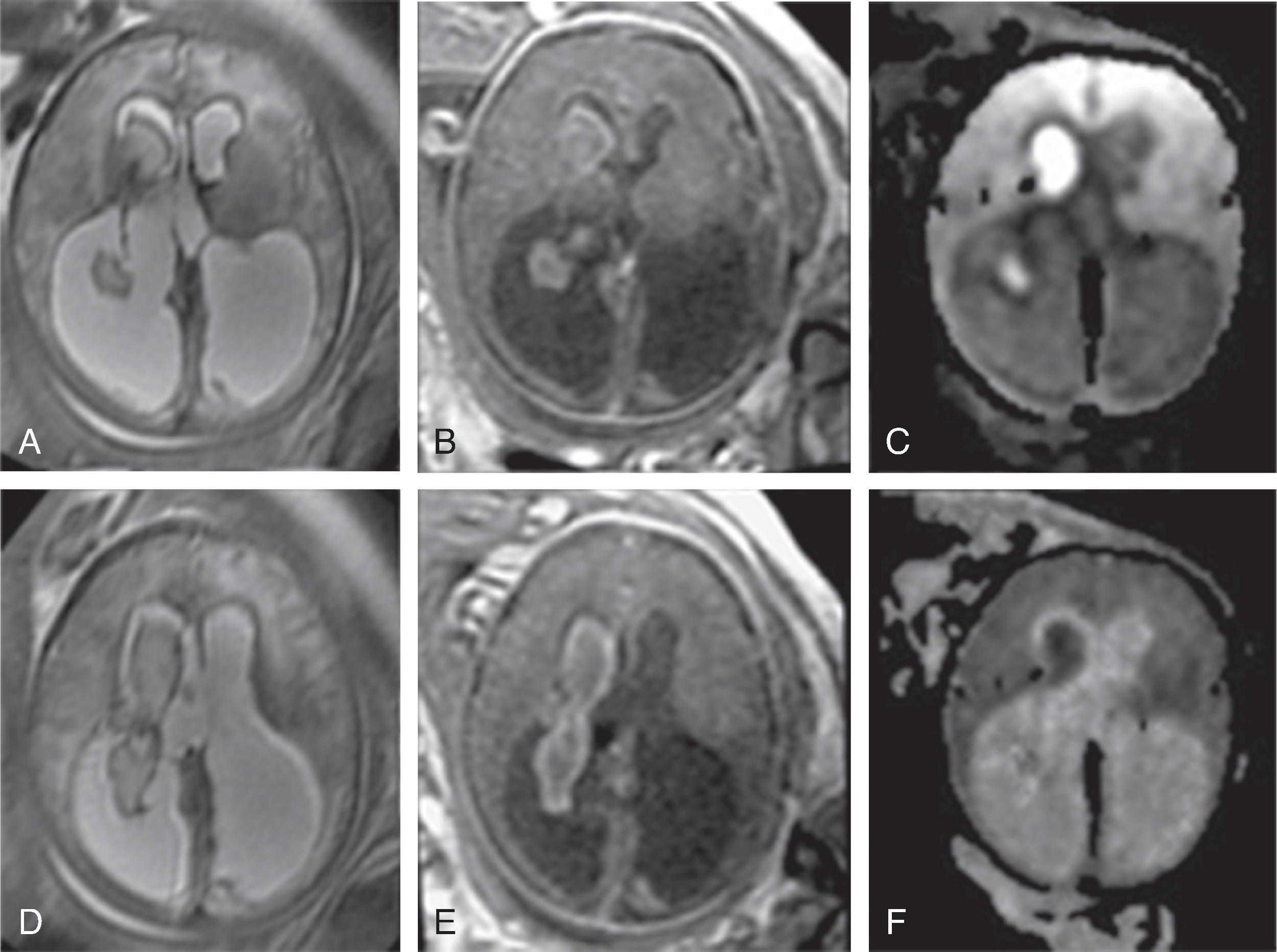 Fig. 3.22, Germinal Matrix Hemorrhage .