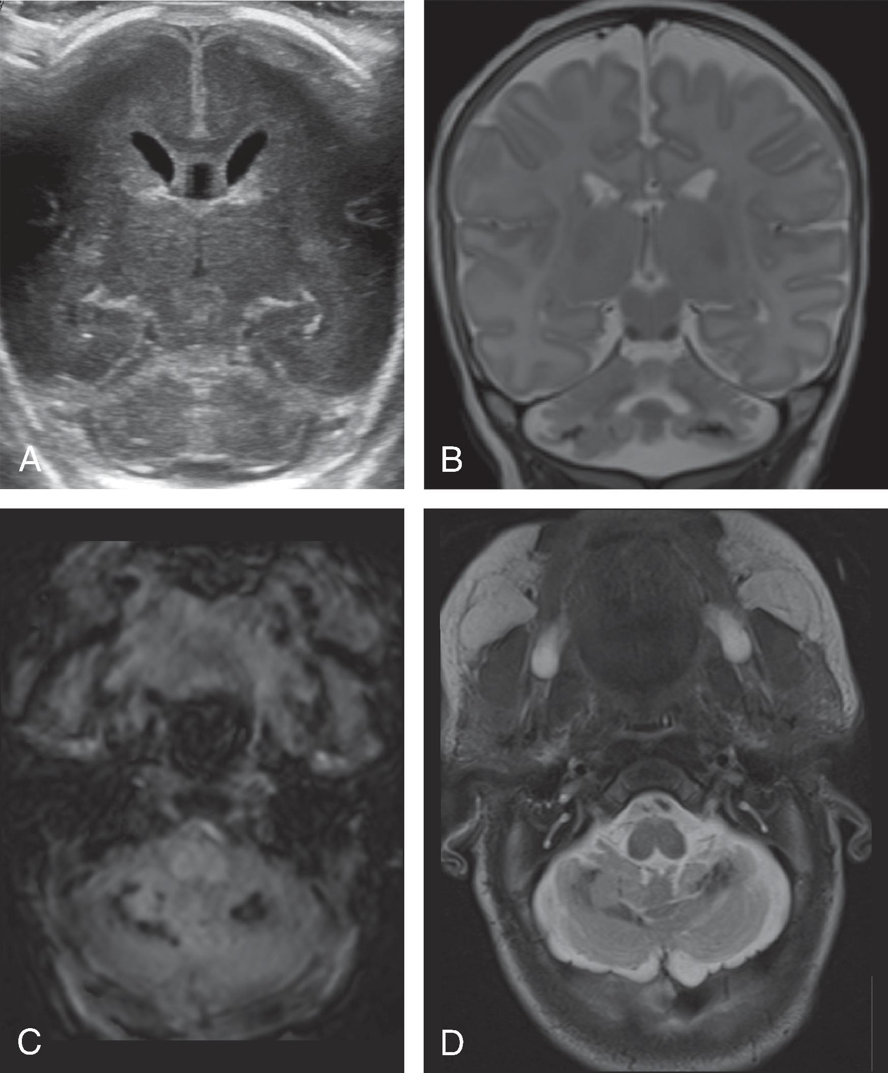 Fig. 3.23, Germinal Matrix Hemorrhage .