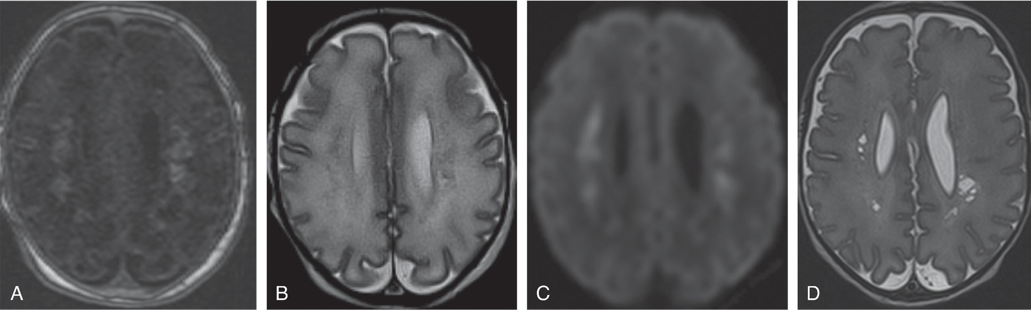 Fig. 3.25, Periventricular Leukomalacia (PVL) .