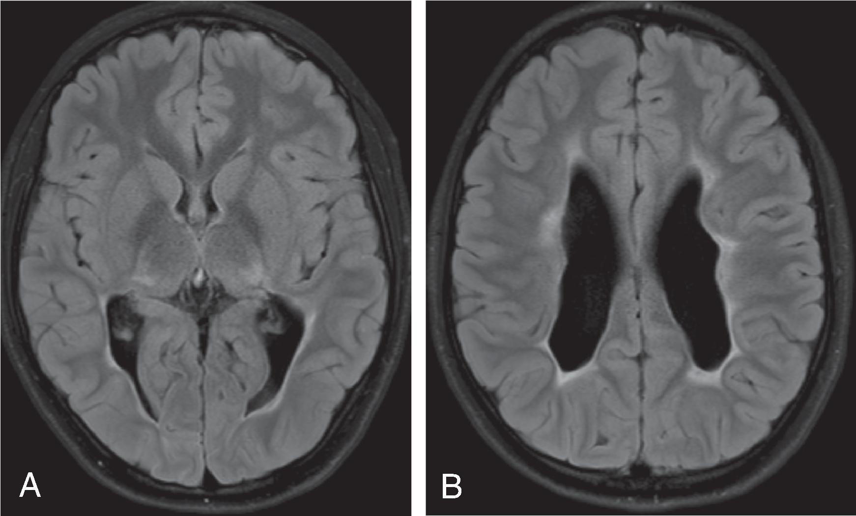 Fig. 3.27, Periventricular Leukomalacia .