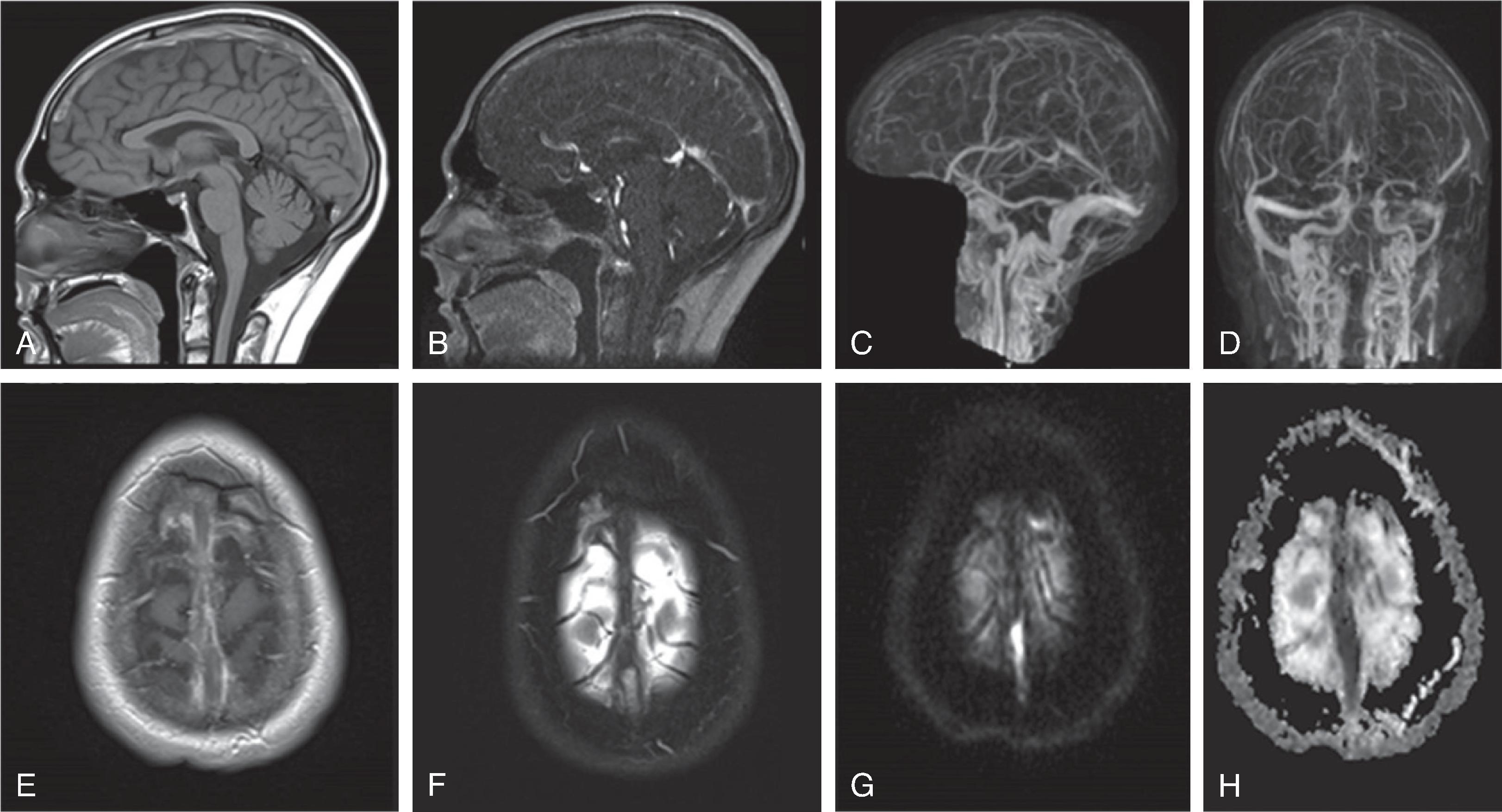 Fig. 3.29, Dural Sinus Thrombosis .