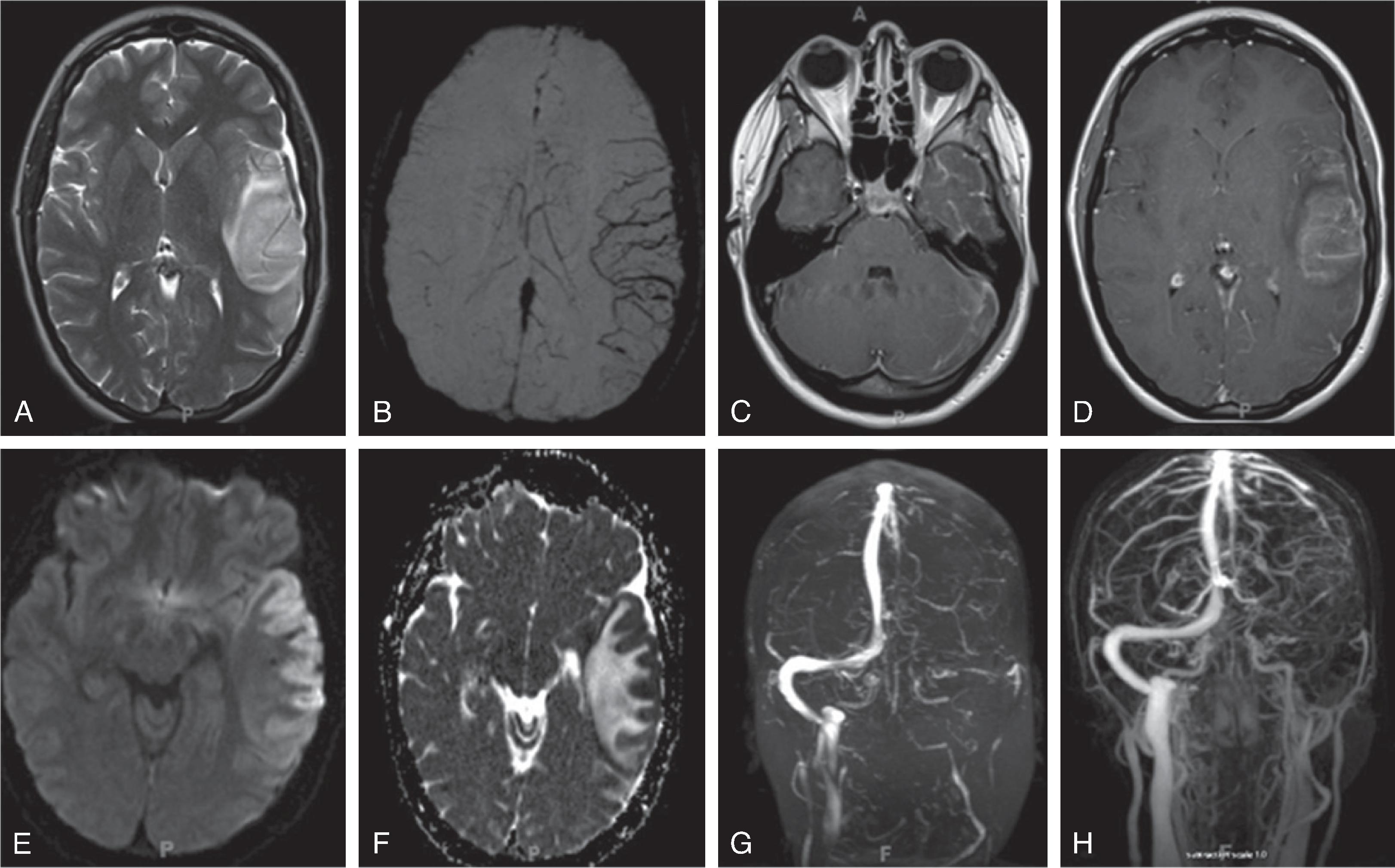 Fig. 3.30, Dural Sinus Thrombosis .