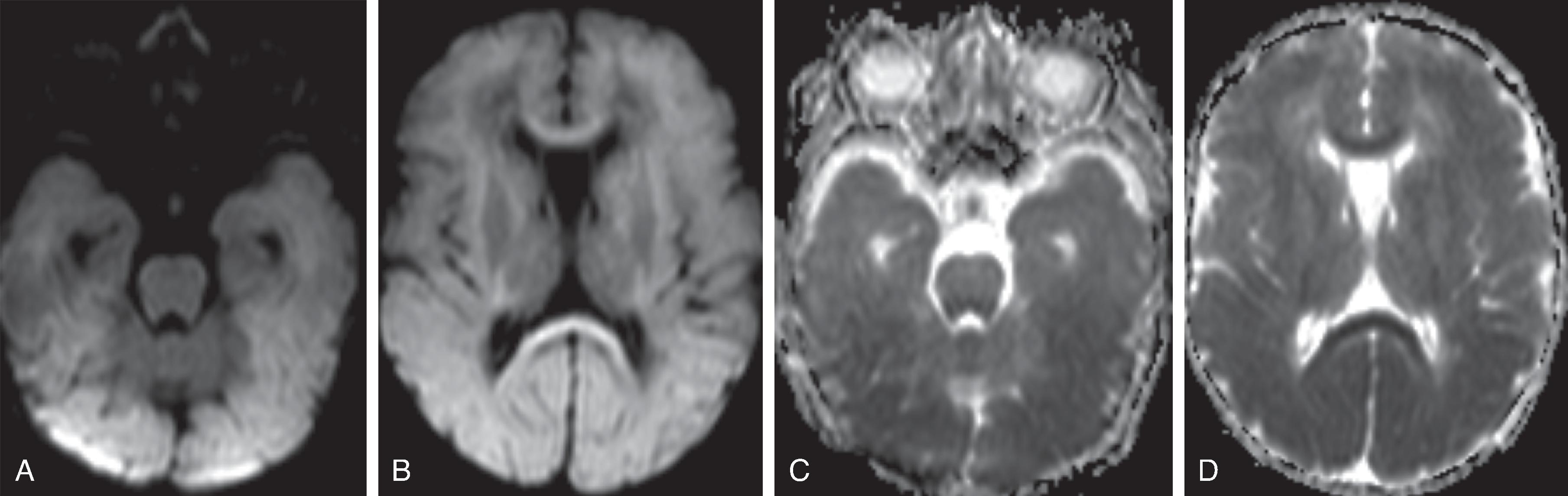 Fig. 3.3, Severe Hypoxic Ischemic Injury .