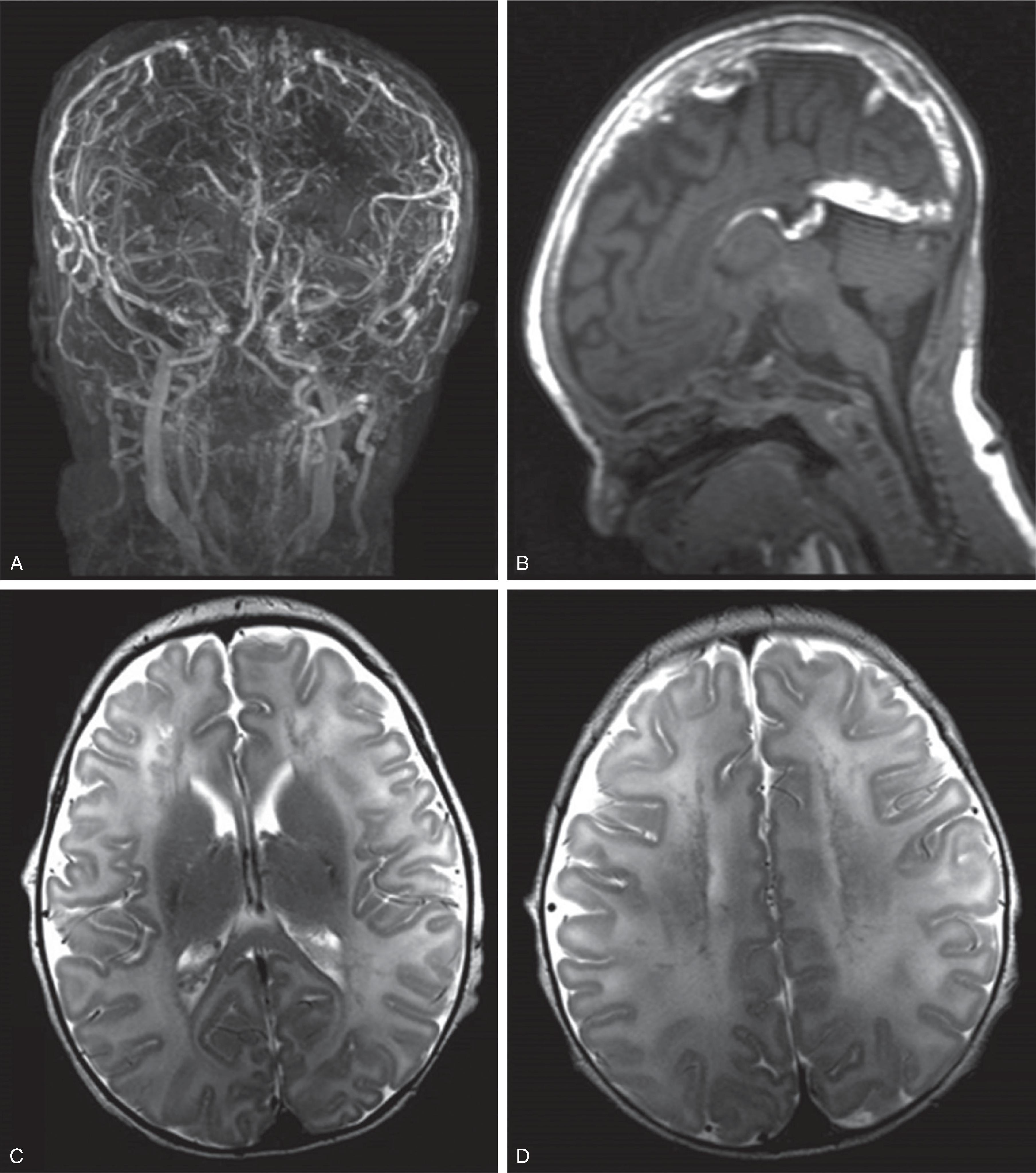 Fig. 3.31, Dural Sinus Thrombosis .