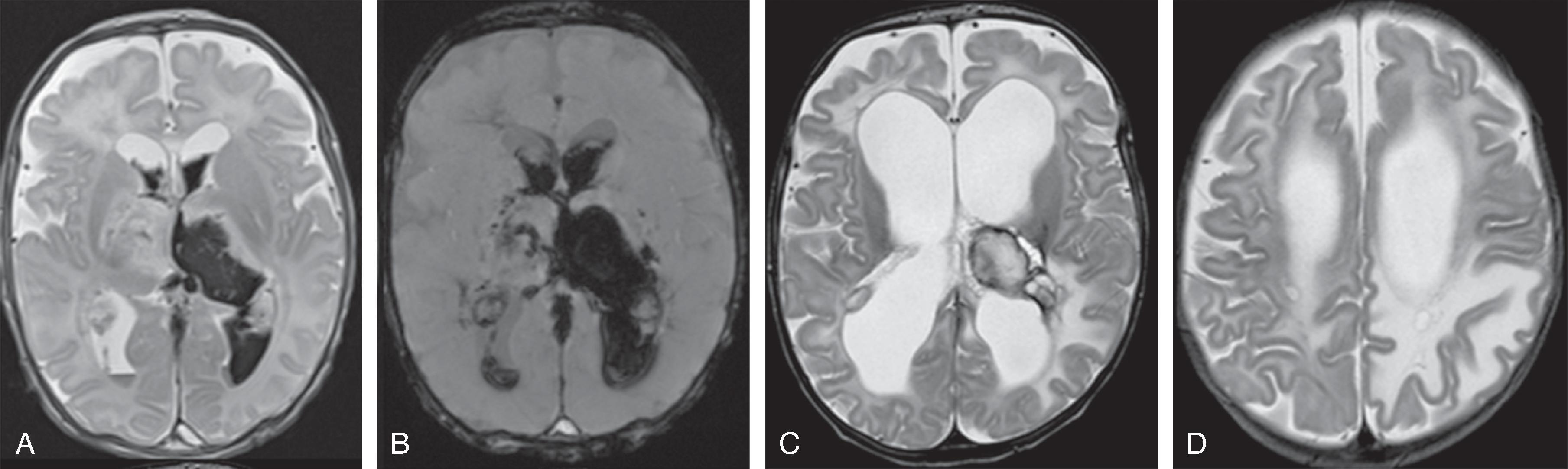 Fig. 3.32, Dural Sinus Thrombosis .