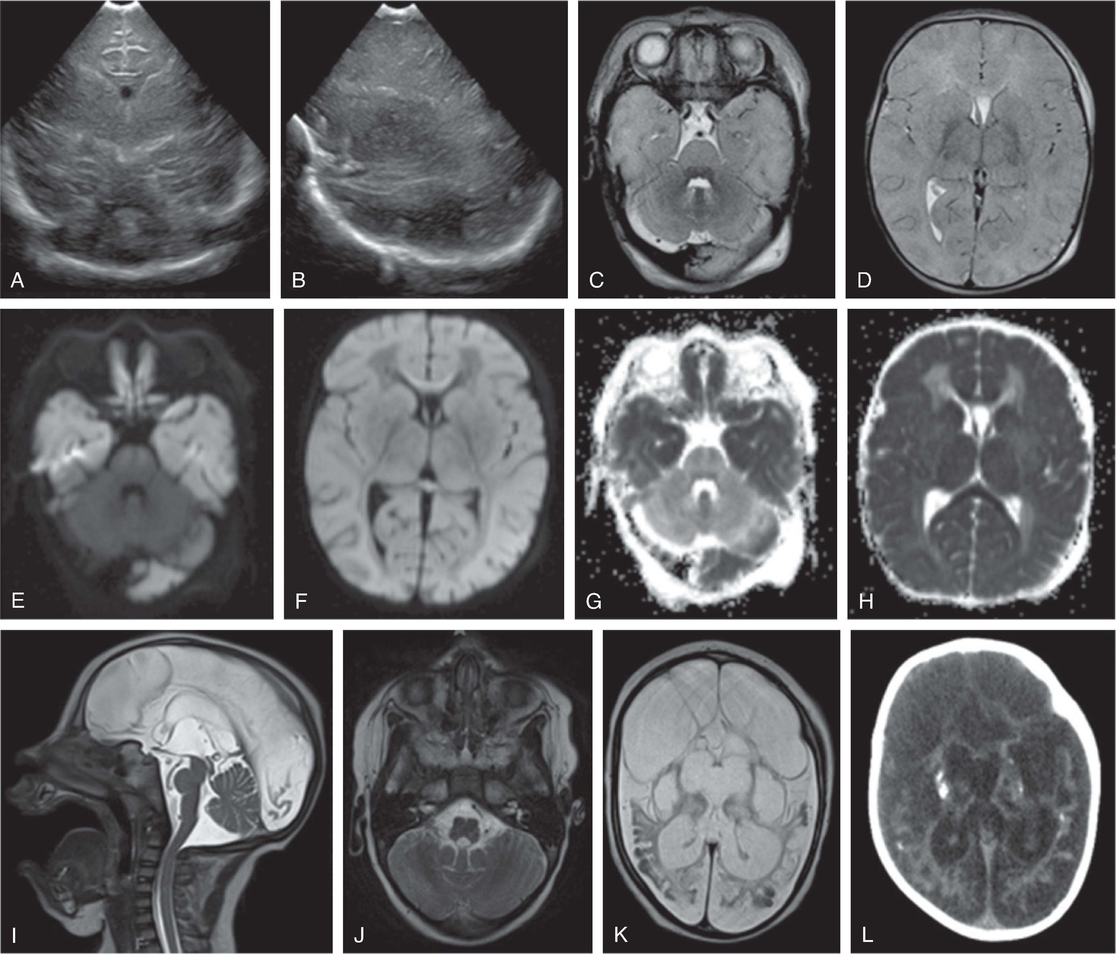 Fig. 3.5, Hypoxic Ischemic Injury .