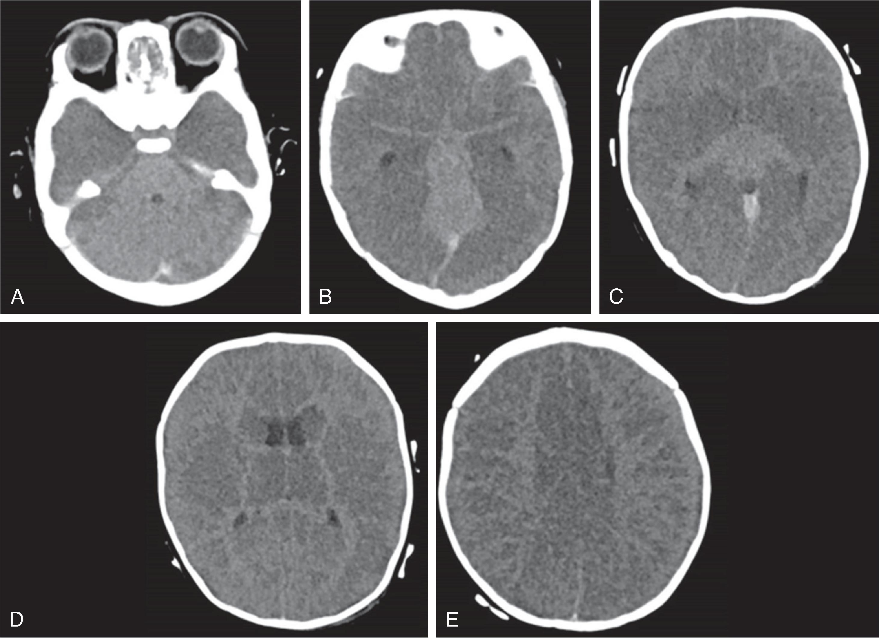 Fig. 3.8, Hypoxic Ischemic Injury .