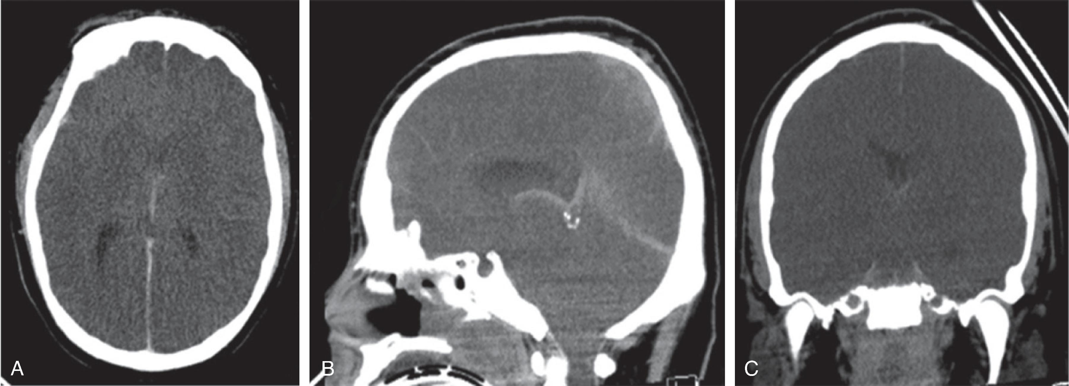 Fig. 3.9, Hypoxic Ischemic Injury .