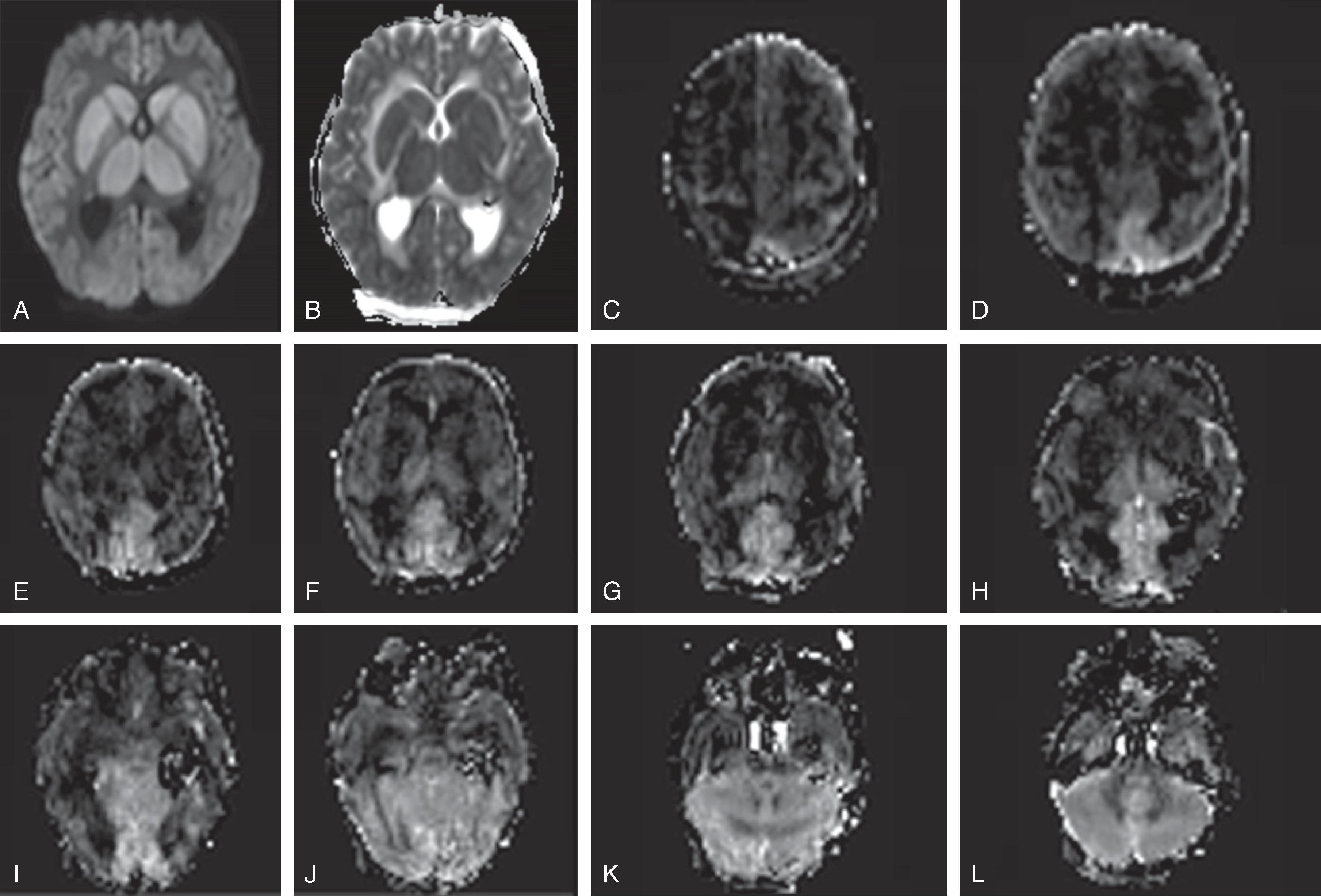 Fig. 3.10, Hypoxic Ischemic Injury .