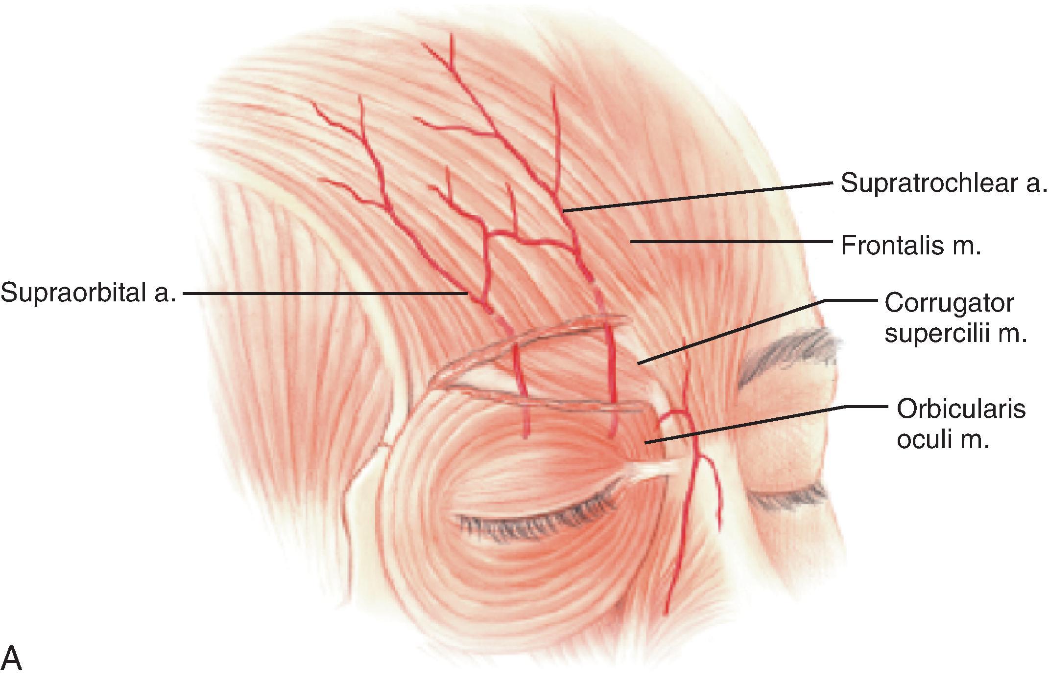 FIG. 13.1, A , Supratrochlear artery exits orbit approximately 2 cm lateral to midline, passing under orbicularis oculi and over corrugator supercilii. At level of eyebrow, supratrochlear and supraorbital arteries pass through orbicularis and frontalis muscles and continue superiorly in superficial subcutaneous tissue plane. B , Vascular territories of arteries supplying forehead skin. (From Baker SR: Interpolated paramedian forehead flaps. In Baker SR [ed]: Principles of Nasal Reconstruction , 2nd ed. Springer, 2011, p 308, Fig. 14.1, with permission.)