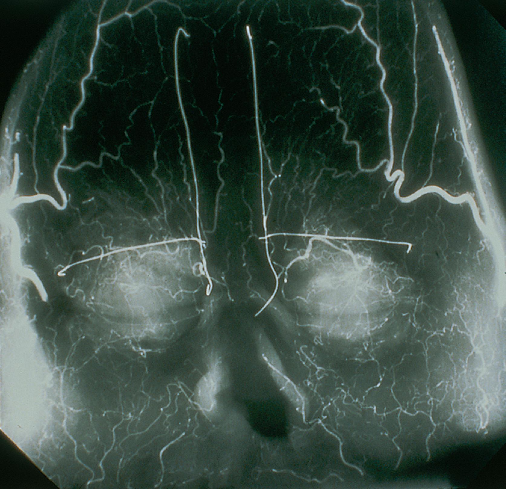 FIG. 13.2, Radiograph showing skin vasculature after injection of contrast medium. Horizontal wire markers delineate superior bony orbital rims. Vertical wires mark medial end of eyebrows. Note intricate system of anastomosing vessels. (From Baker SR: Interpolated paramedian forehead flaps. In Baker SR [ed]: Principles of Nasal Reconstruction , 2nd ed. Springer, 2011, p 309, Fig. 14.2, with permission.)