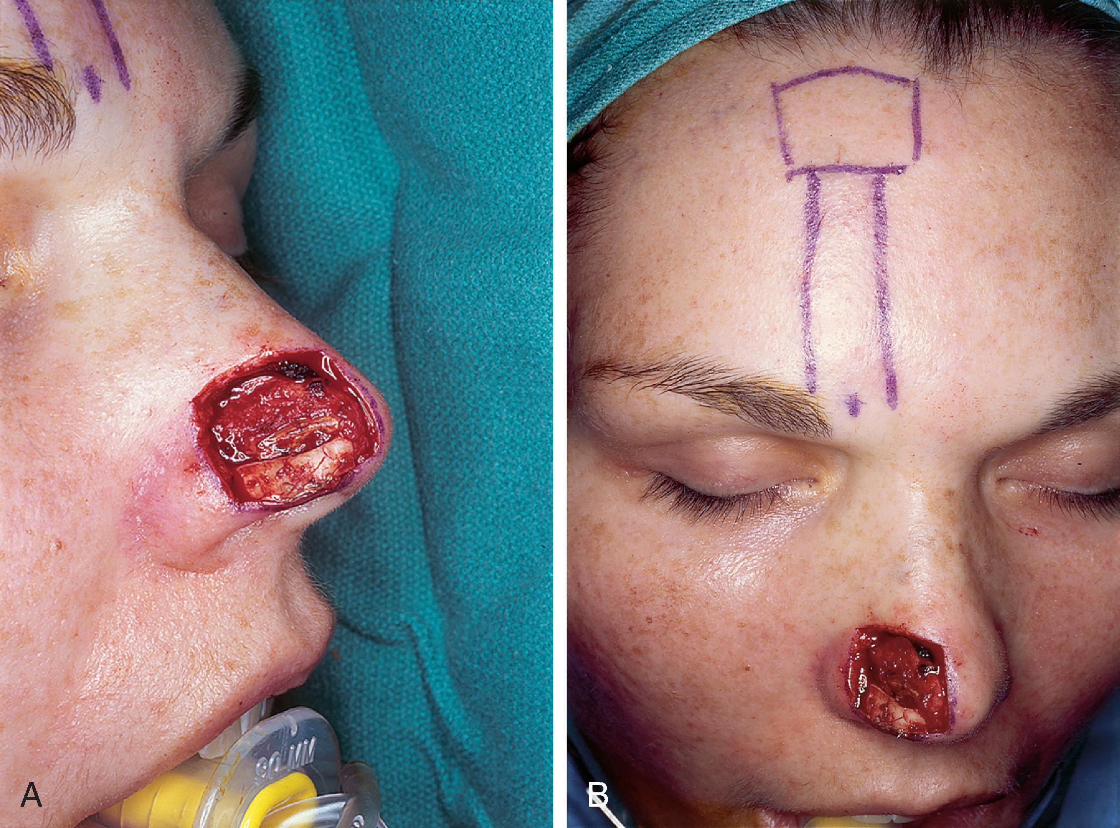 FIG. 13.3, A , Hemi-nasal cutaneous defect. Auricular cartilage graft placed along nostril rim for structural support. B , Paramedian forehead flap designed for reconstruction of nose. Centering pedicle over vertical axis of supratrochlear artery enables narrow pedicle 1.2 cm wide. C , D , Narrow pedicle provides greater effective length and smaller standing cutaneous deformity than wider pedicle. E–H , Preoperative and 1.5 years postoperative. No revision surgery performed.