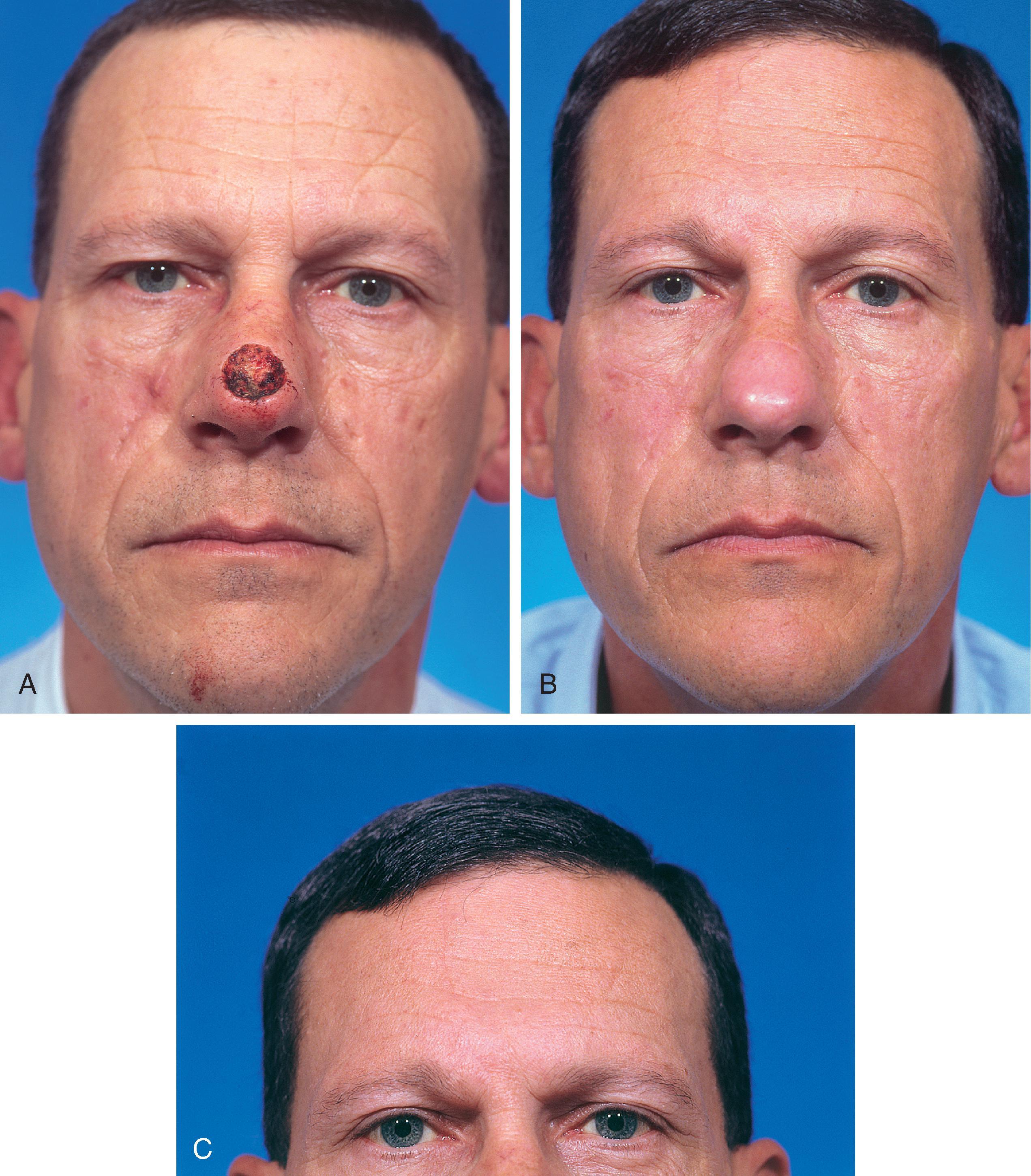 FIG. 13.4, A , A 1.5 × 1.8 cm cutaneous defect of the nasal tip. B , Eight months after repair of defect with paramedian forehead flap. C , Donor site forehead scars are rarely unsightly. No revision surgery performed.