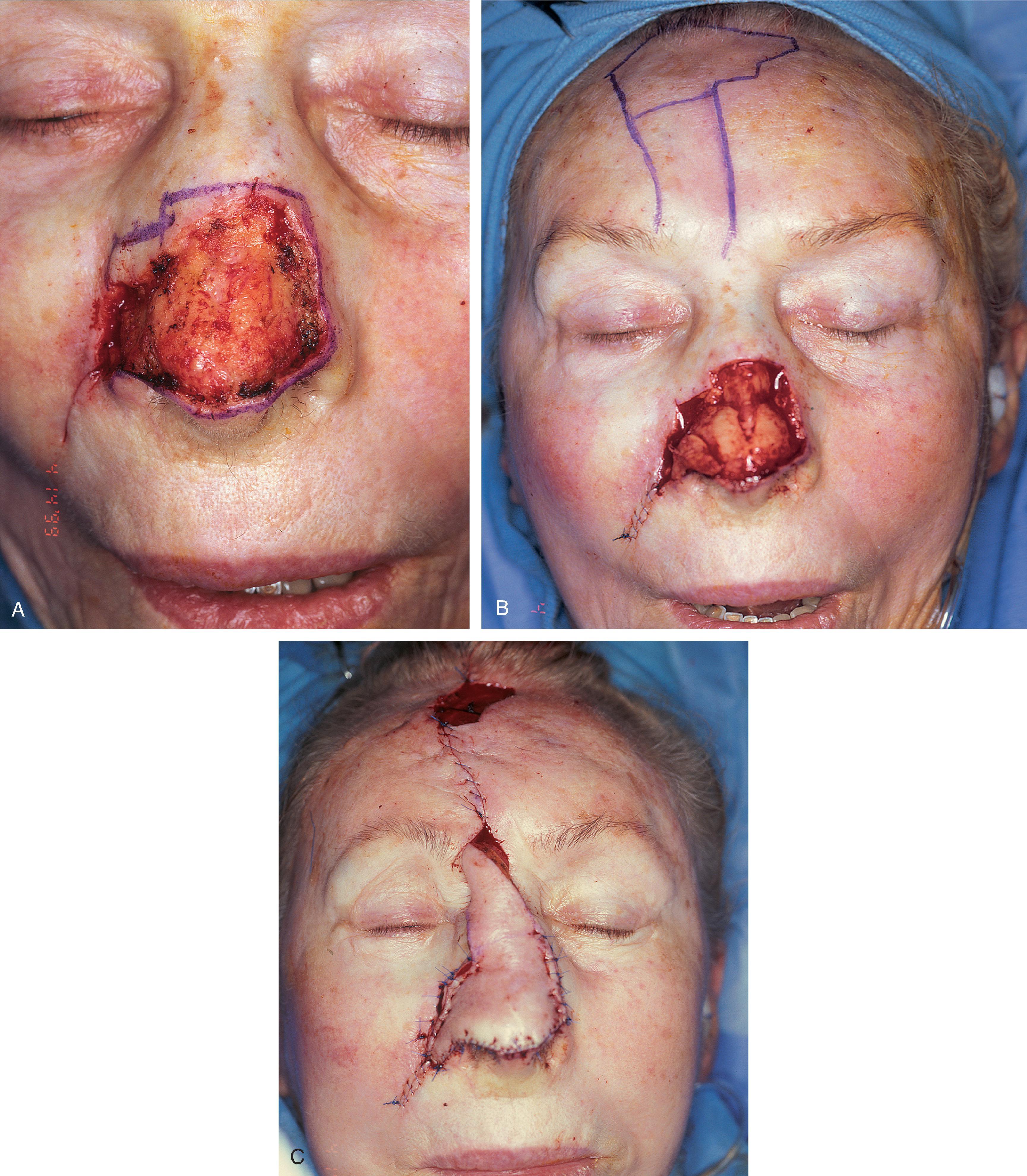 FIG. 13.5, A , A 5 × 4 cm cutaneous defect of nasal tip, caudal dorsum, and right ala. B , Paramedian forehead flap designed for repair . C , Flap in place. Flaps wider than 4.5 cm are too large to allow complete wound closure of donor site. Portion of superior donor site wound left to heal by secondary intention. D–G , Preoperative and 9 months postoperative. Contouring procedure to restore alar groove performed 6 months postoperative. No revision surgery performed on forehead scar.