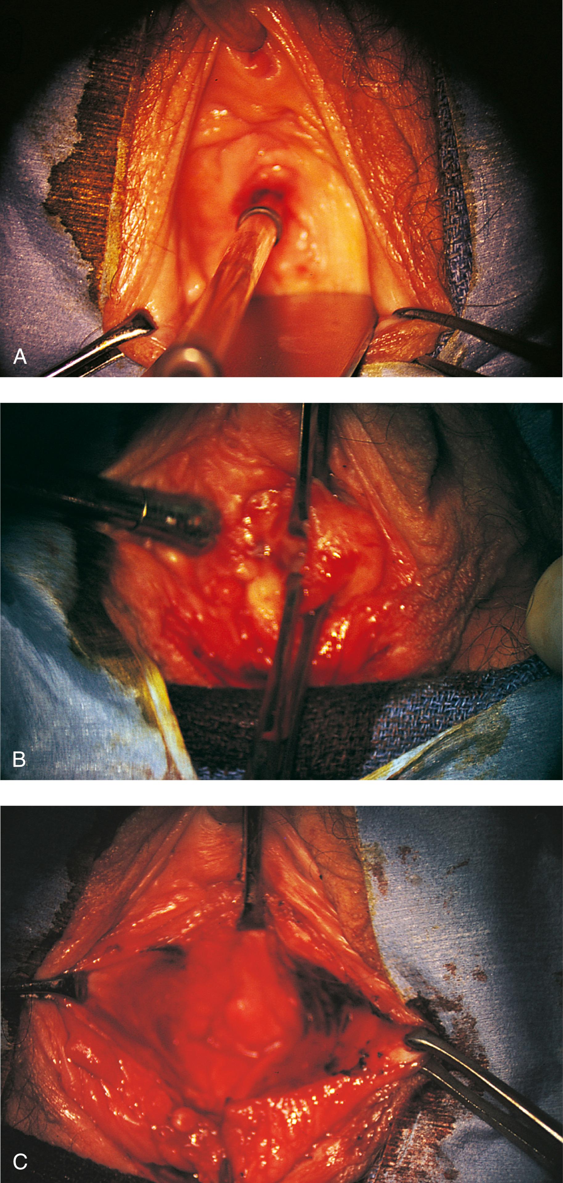 FIG. 60.5, A. Midvaginal constriction ring that occurred after an overzealous anterior and posterior repair. The image shows the Hegar dilator in the small opening. B. Because the vagina was sufficient above this ring, bilateral relaxing incisions were performed to reopen the vagina. Allis clamps were used to grasp the ring in preparation for the incision. An incision was made at both 4 and 7 o’clock. C. The incisions were continued until the band was completely incised and loose areolar tissue was encountered. The incision was left open to heal by secondary intention.