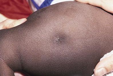 Figure 8.1, Deep dimple and scar on the buttock of an infant as a sequella of amniocentesis.