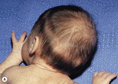 Figure 8.7, (A) Halo scalp ring: a band of alopecia resulting from localized injury during the birth process. (B) Halo scalp ring with tissue necrosis 1 week after birth. (C) Halo scalp ring healed with scarring alopecia.